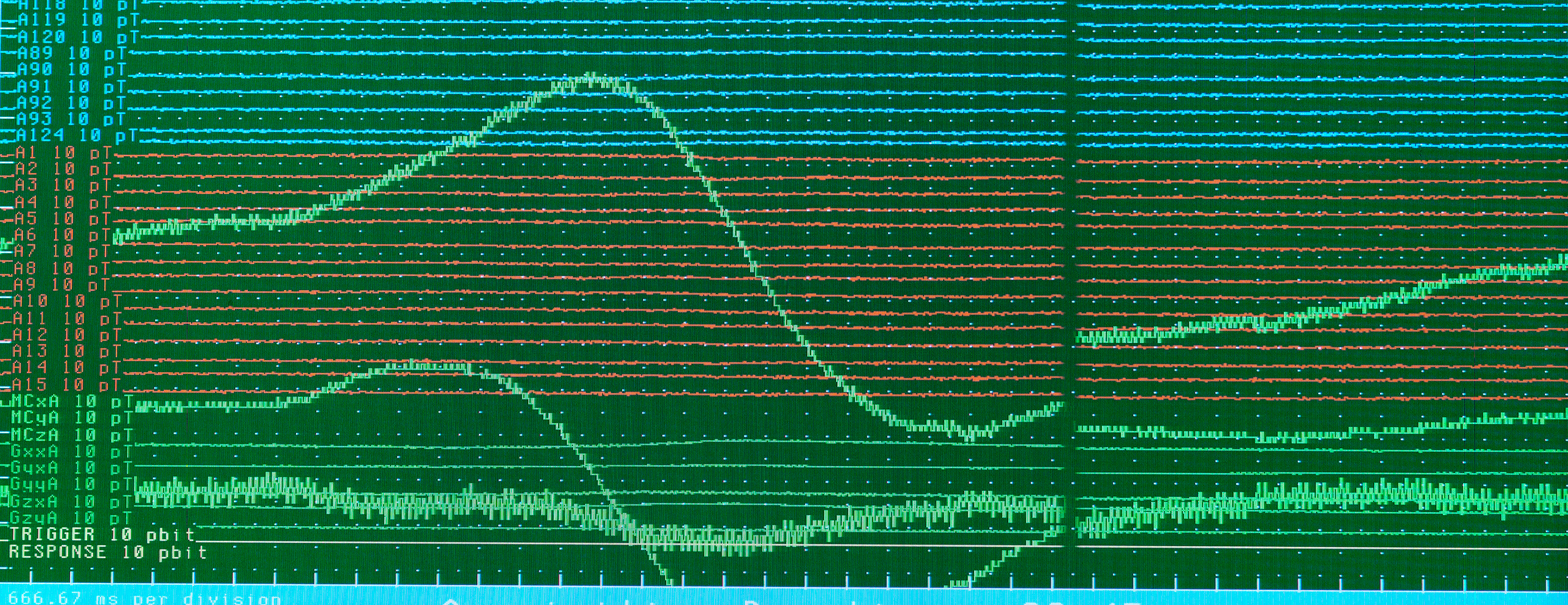 magnetoencephalography-meg-scan-2x