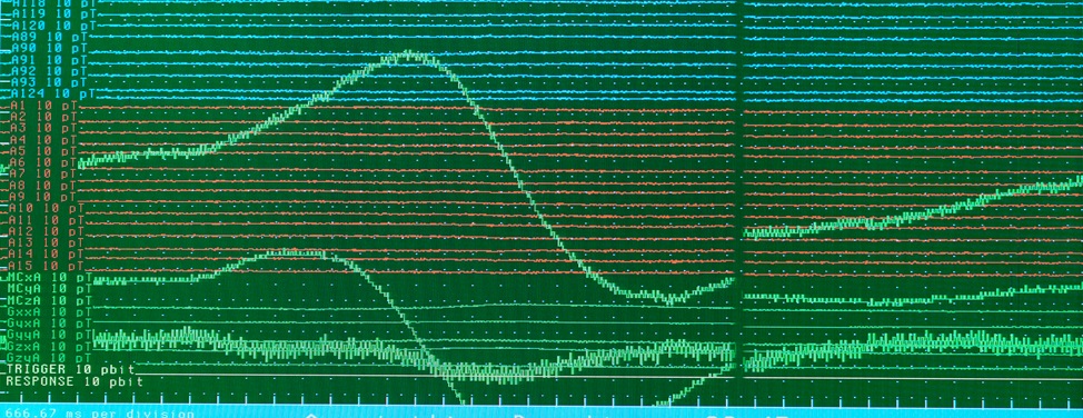 magnetoencephalography-meg-scan-2x