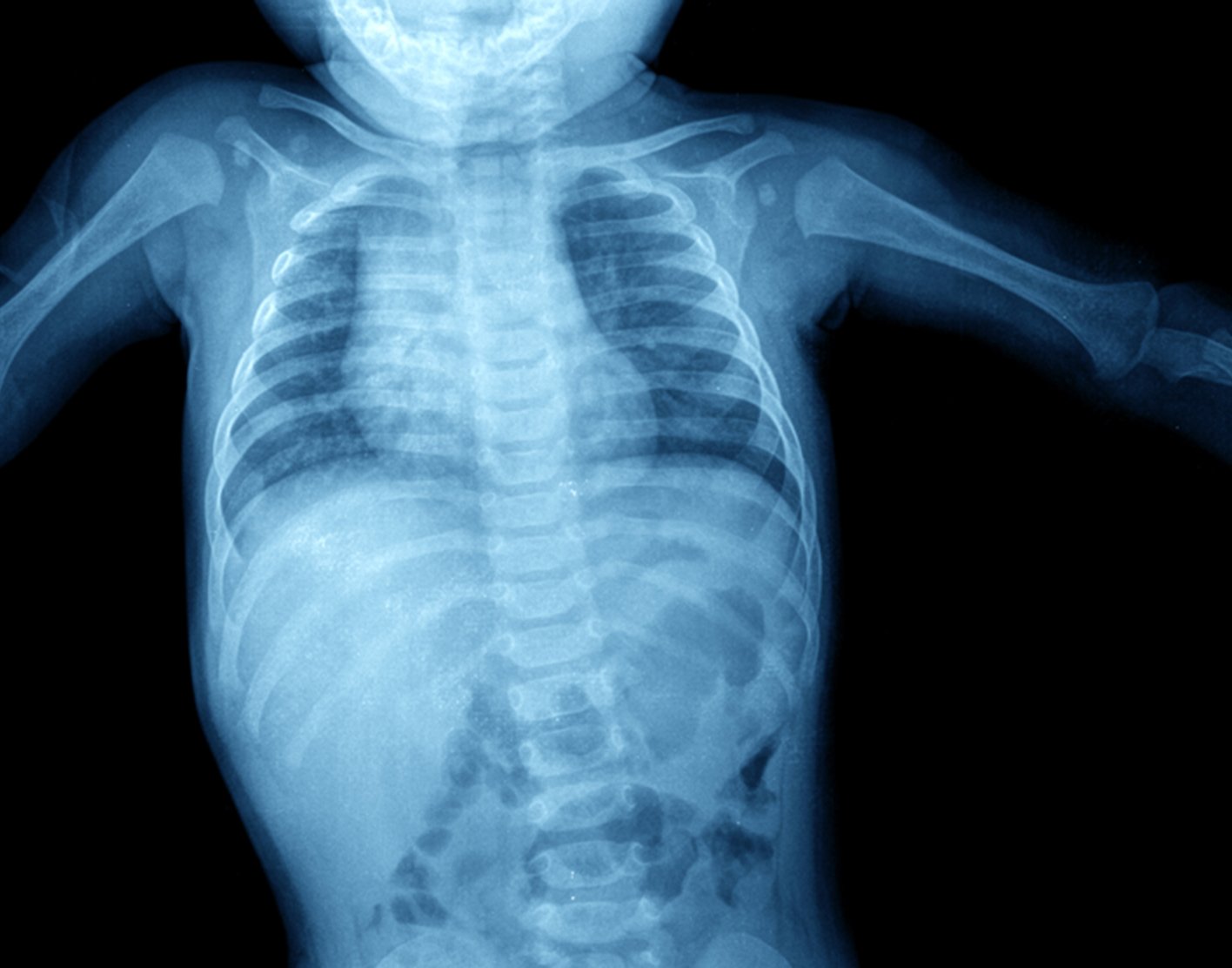 Abdominal X Ray