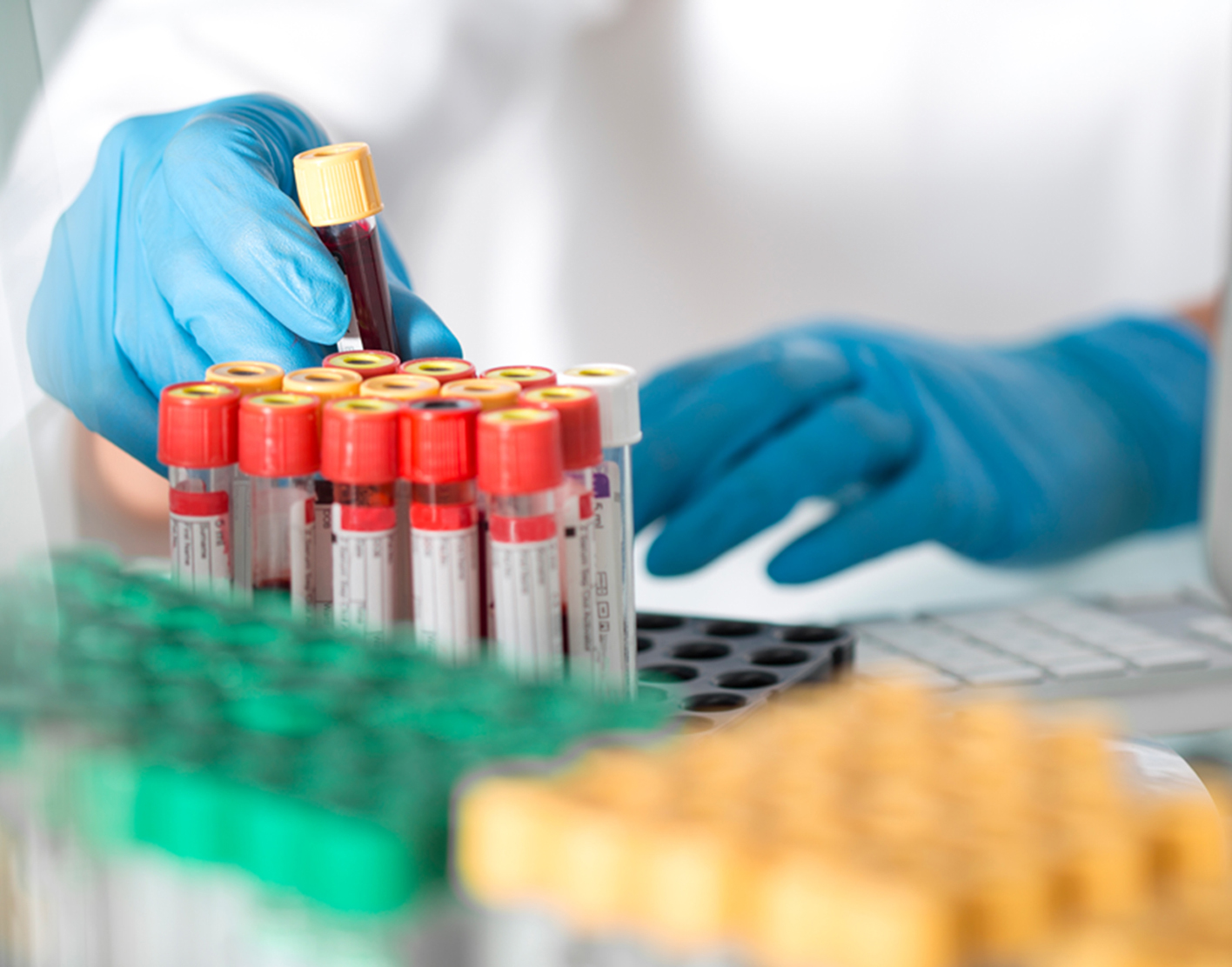 acth-blood-test-708x556-2x