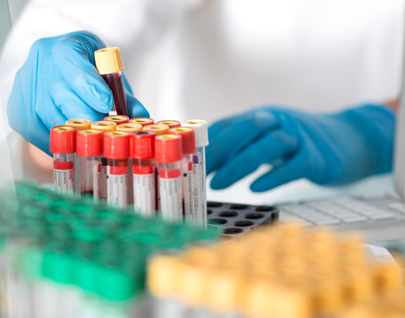 aldolase-blood-test-708x556-2x