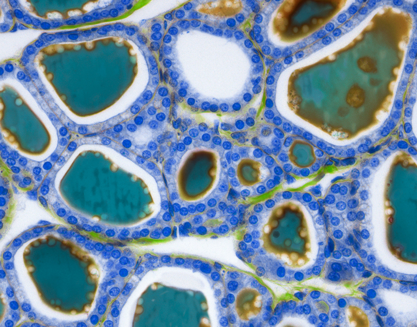 Antithyroglobulin antibody test