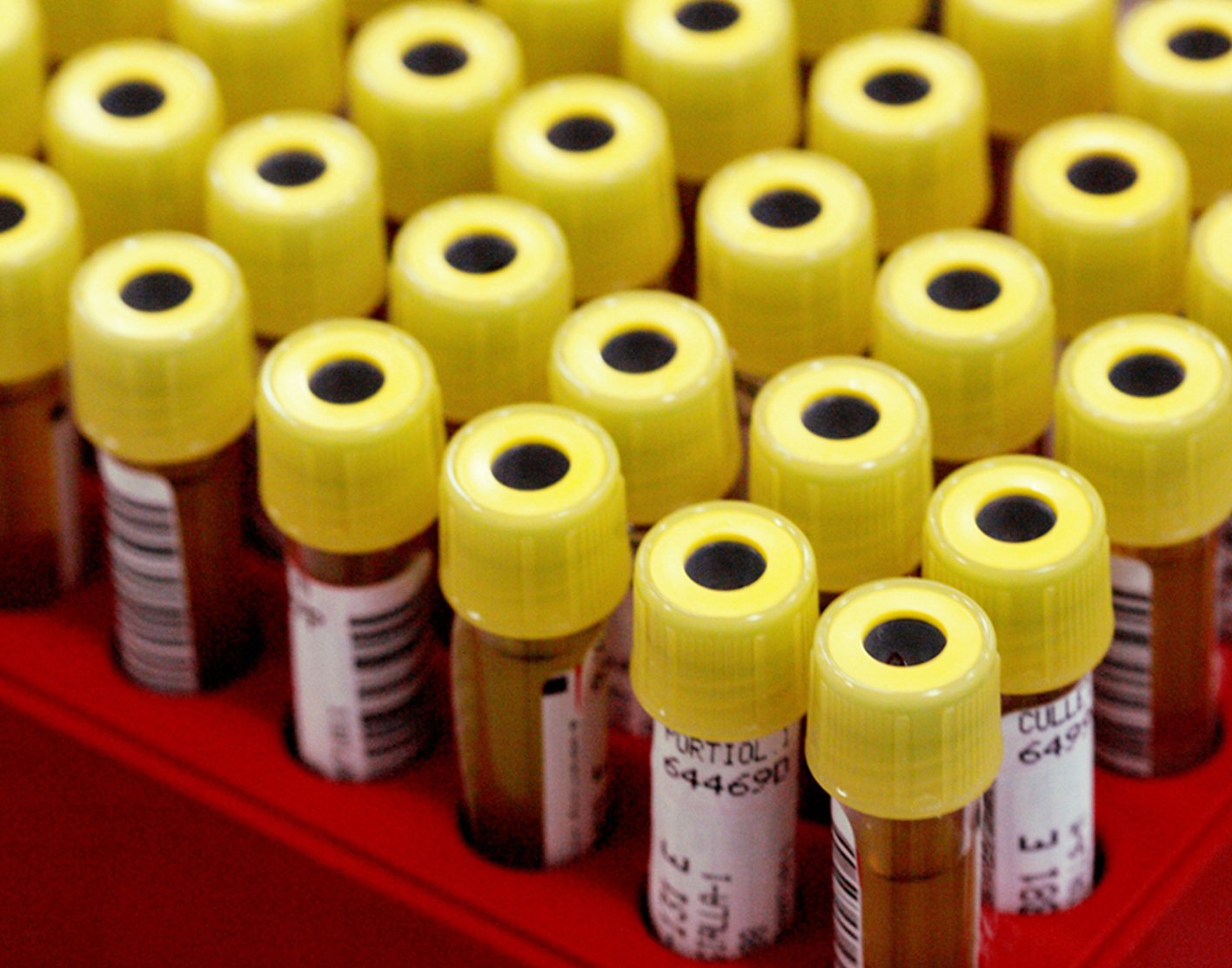 aspartate-aminotransferase-ast-blood-test-708x556-2x