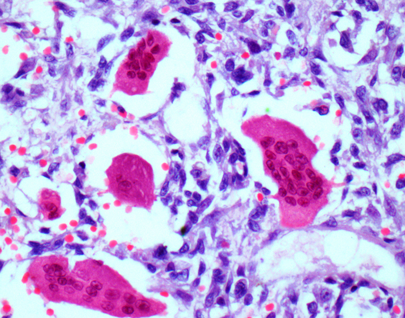 bone-lesion-biopsy-708x556-2x