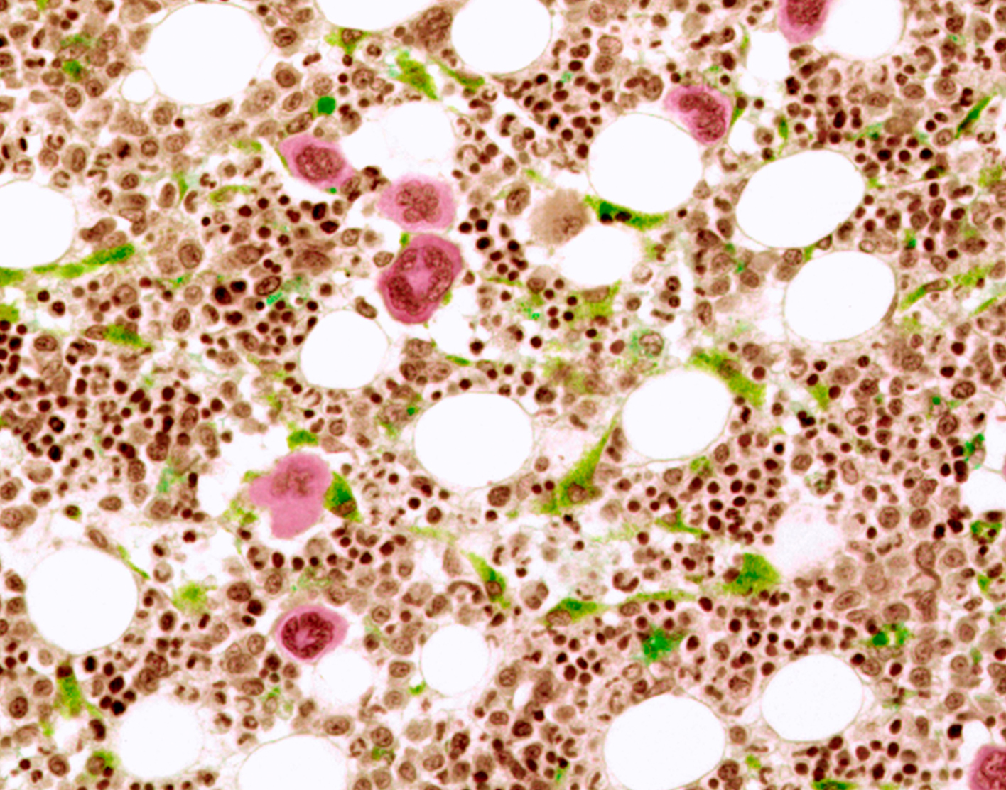 bone-marrow-aspiration-708x556-2x