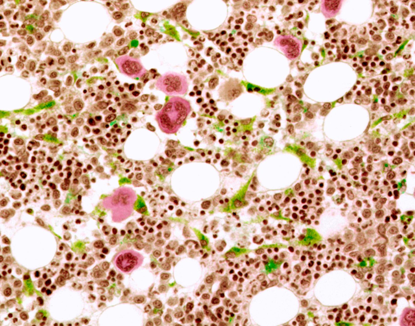 bone-marrow-aspiration-708x556-2x