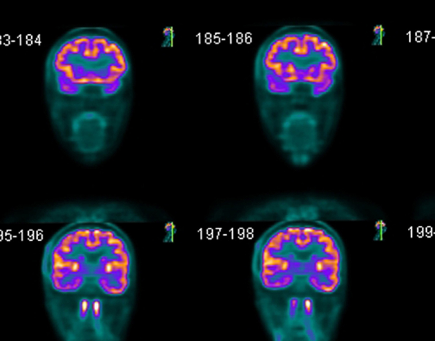 Brain PET Scan Brain pet scan