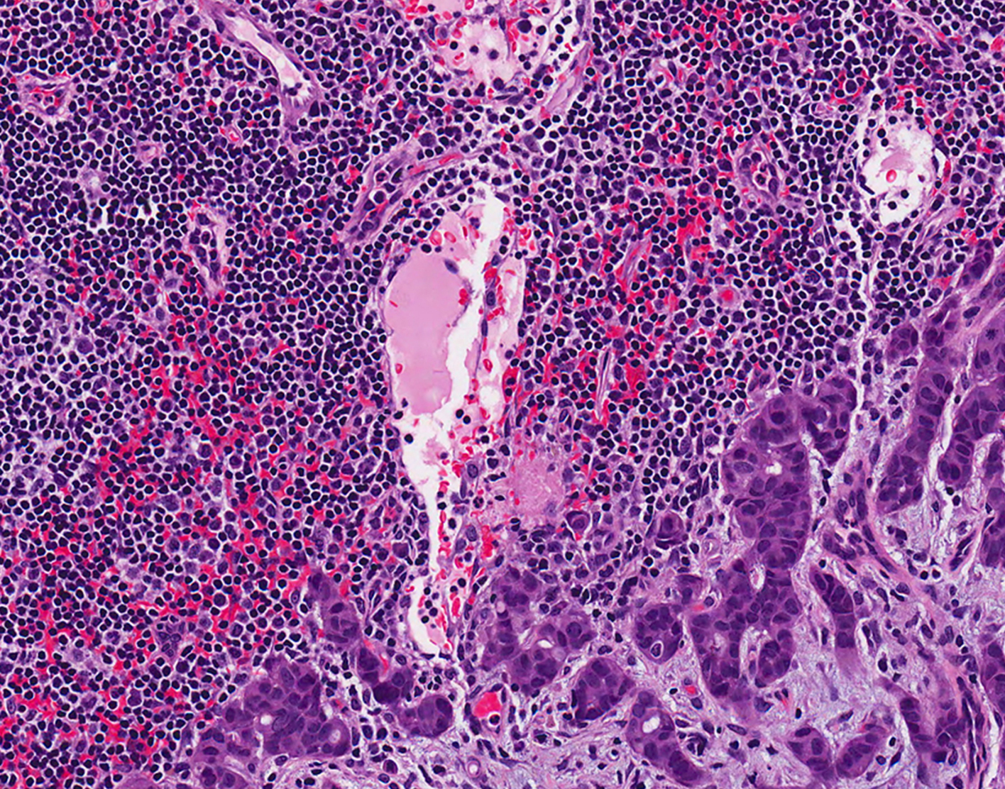 breast-biopsy-ultrasound-708x556-2x