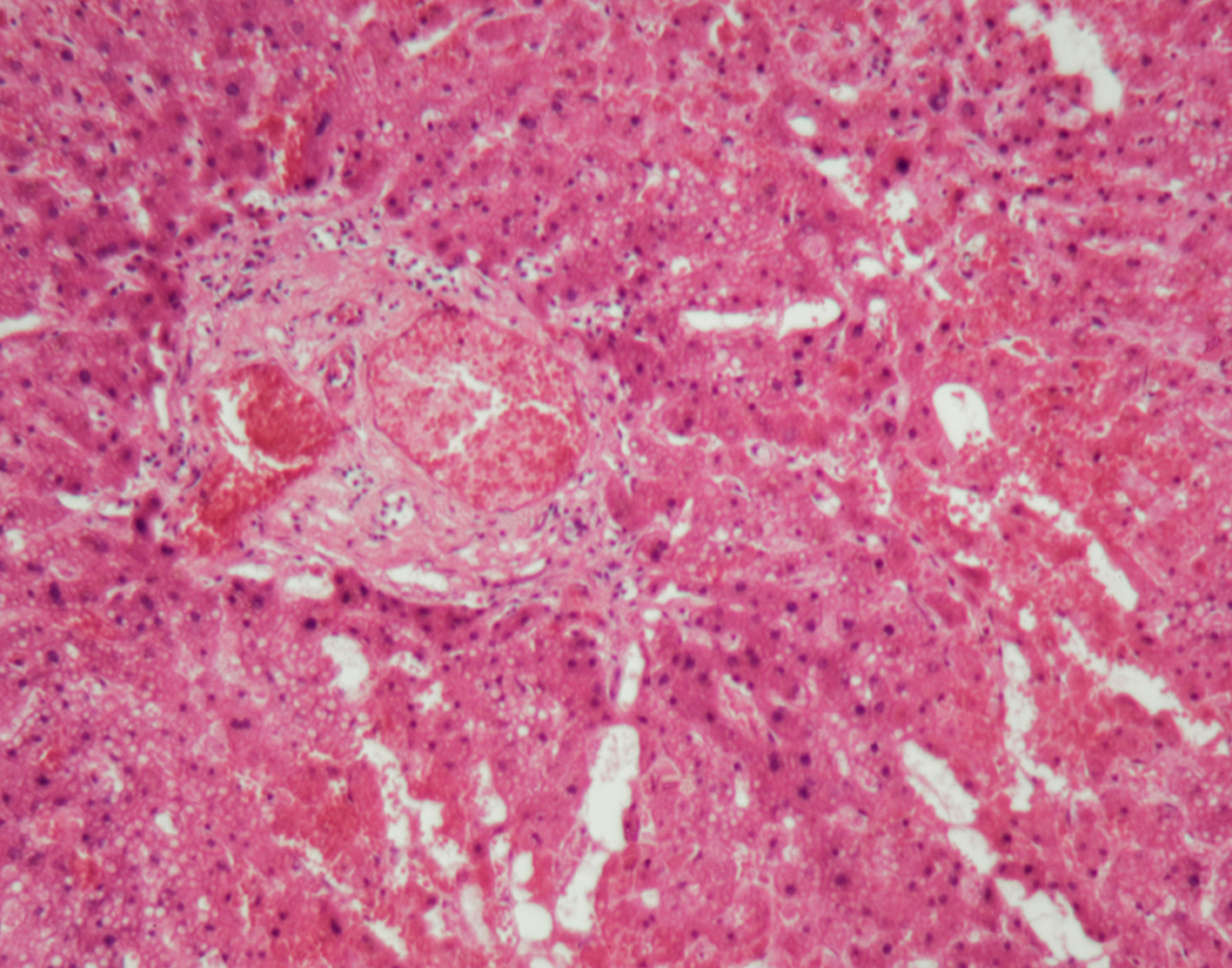 carpal-tunnel-biopsy-708x556-2x