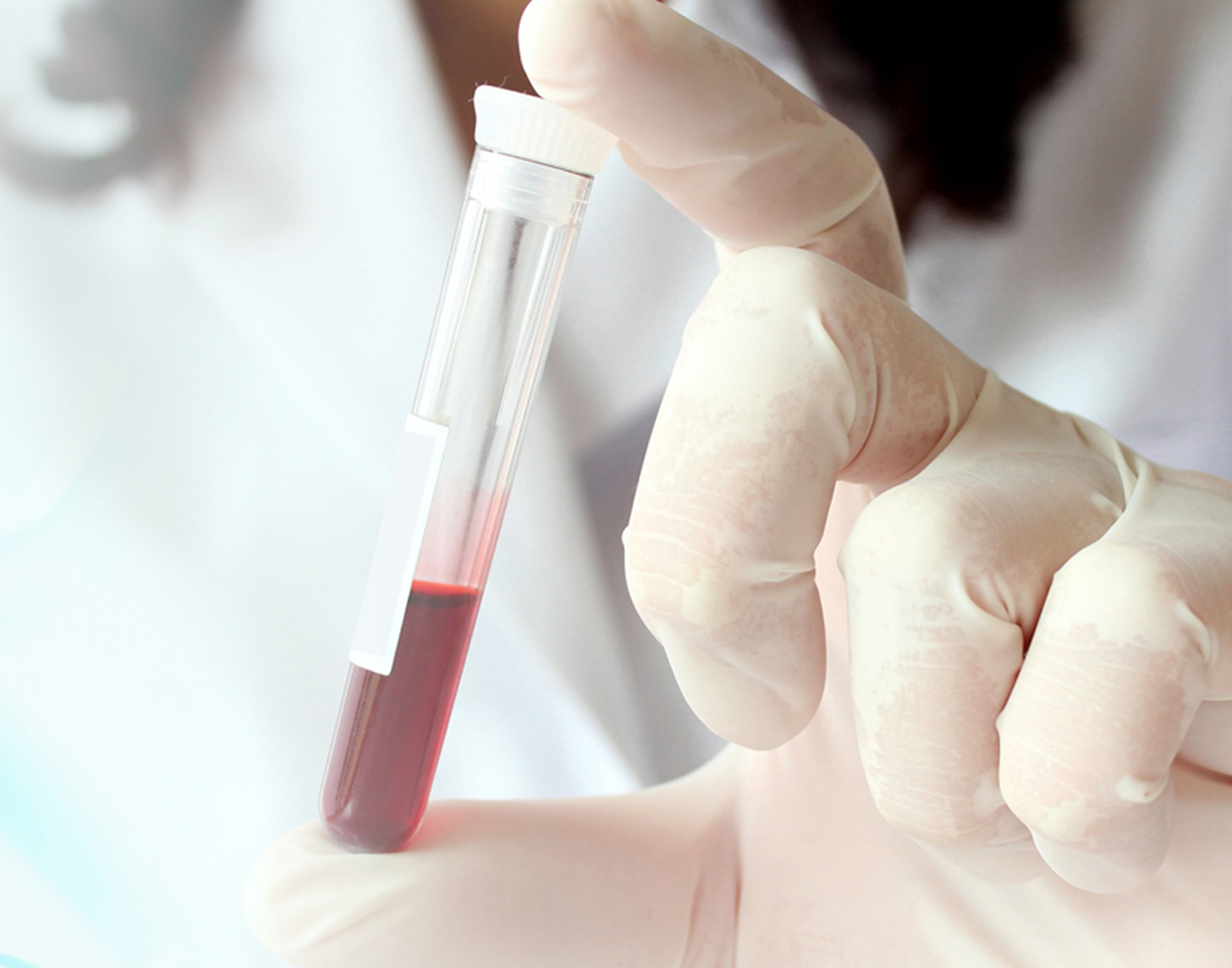 catecholamine-blood-test-708x556-2x