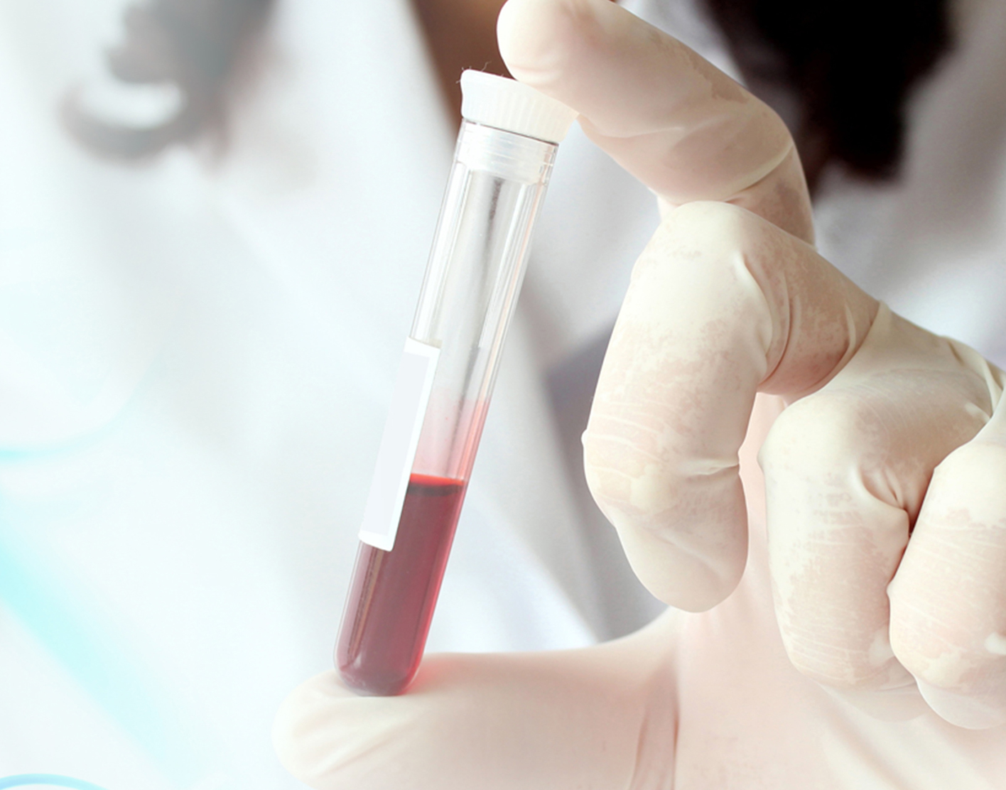 cea-blood-test-708x556-2x