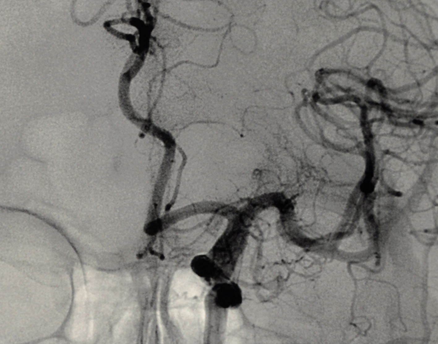cerebral-angiography-708x556-2x