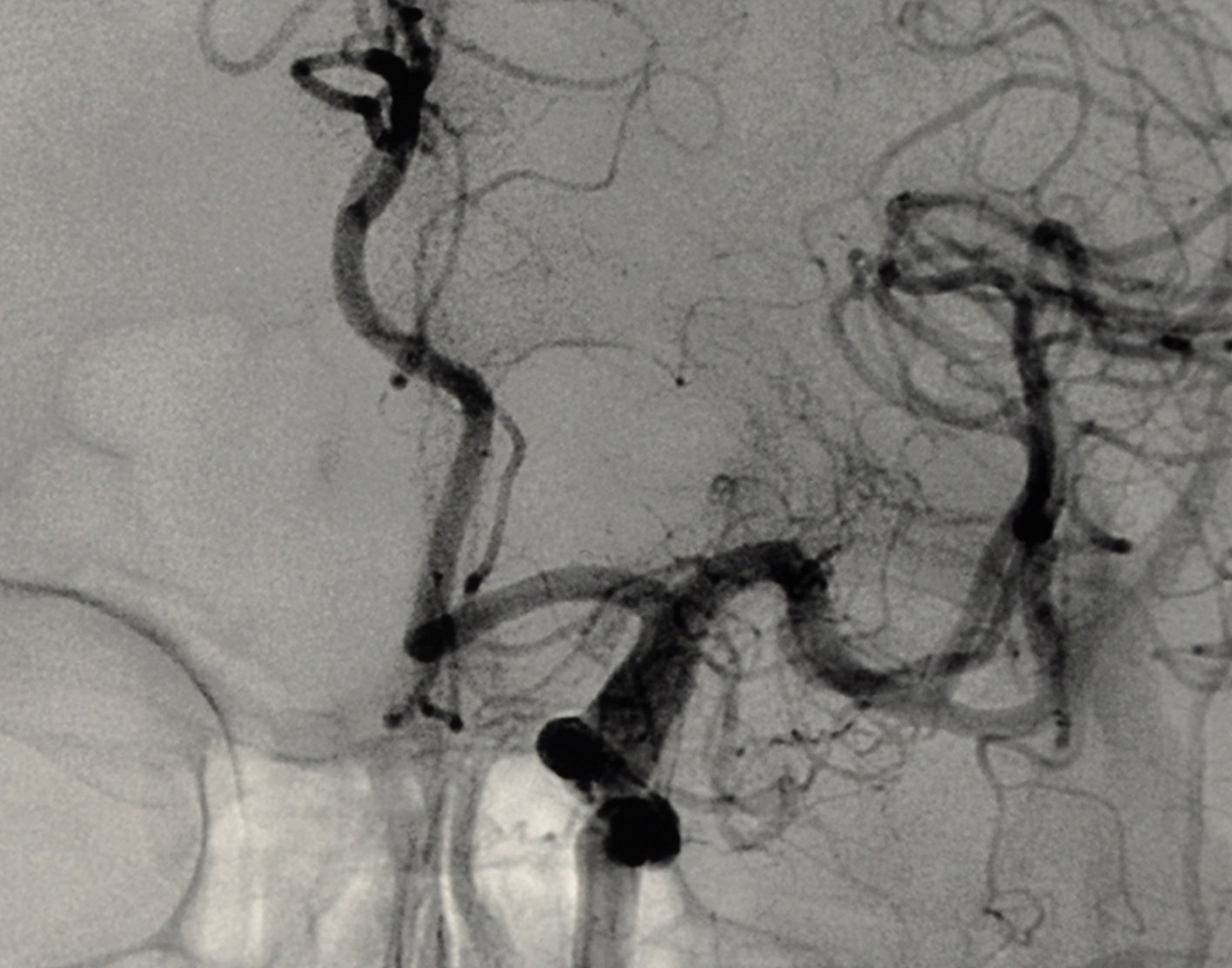 cerebral-angiography-708x556-2x