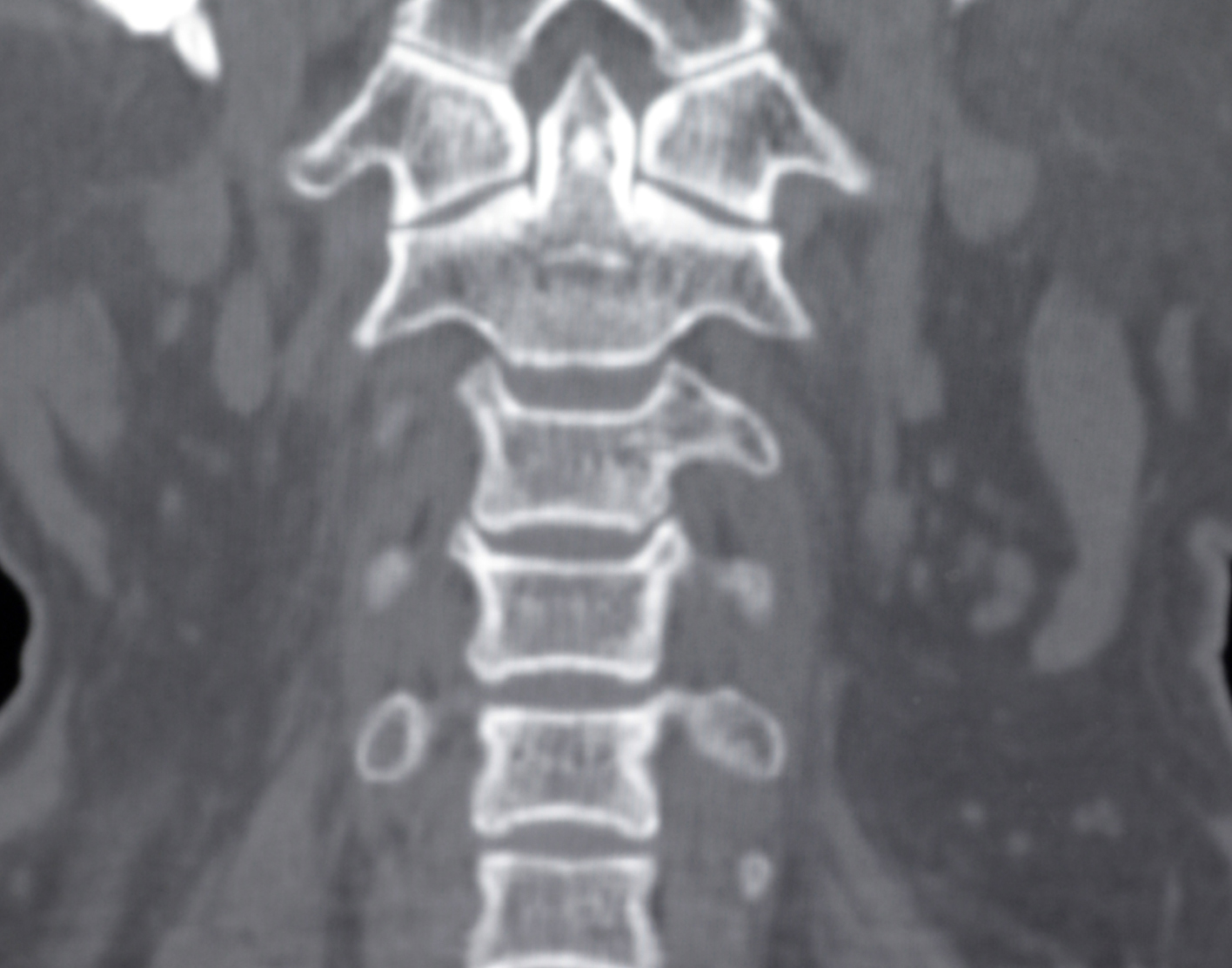 cervical-spine-ct-scan-708x556-2x