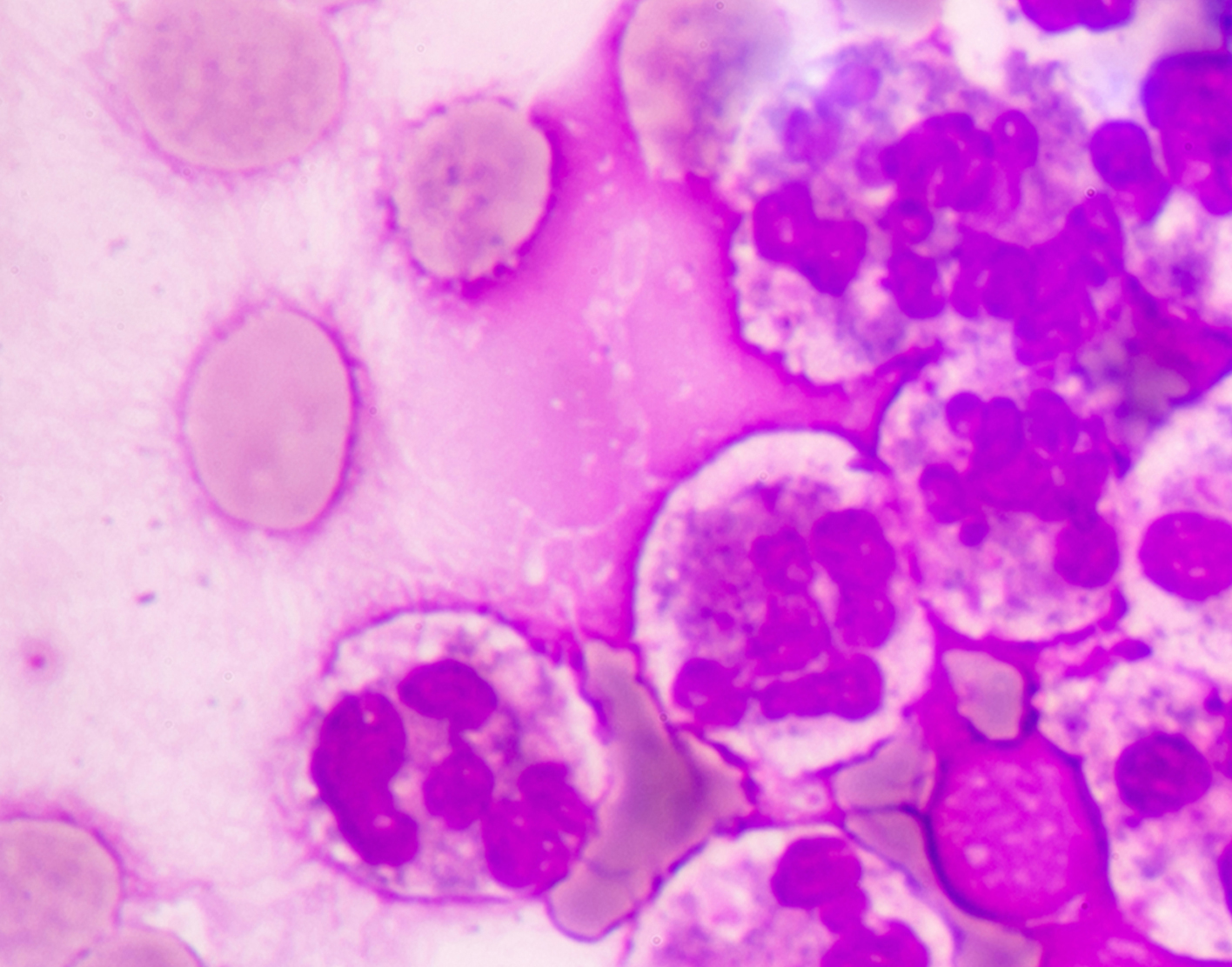 cytology-exam-of-pleural-fluid-708x556-2x