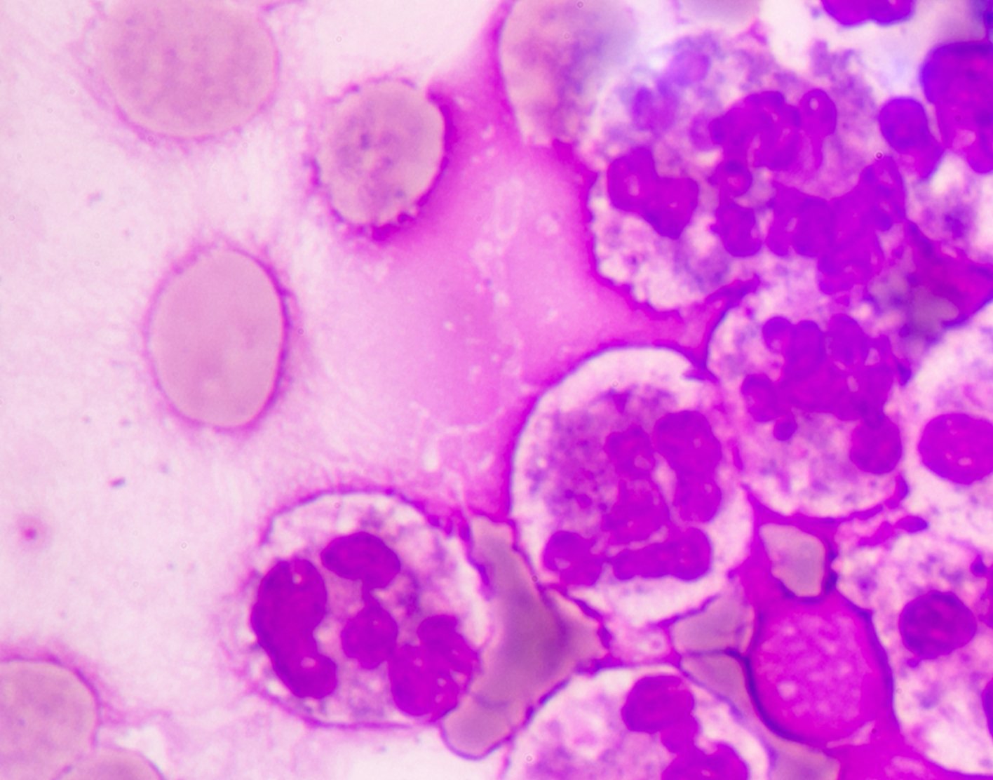 cytology-exam-of-pleural-fluid-708x556-2x