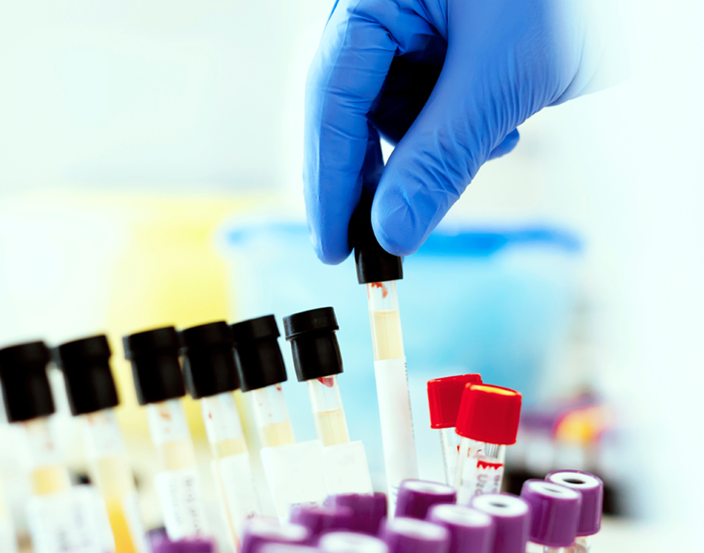 cytology-exam-of-urine-708x556-2x