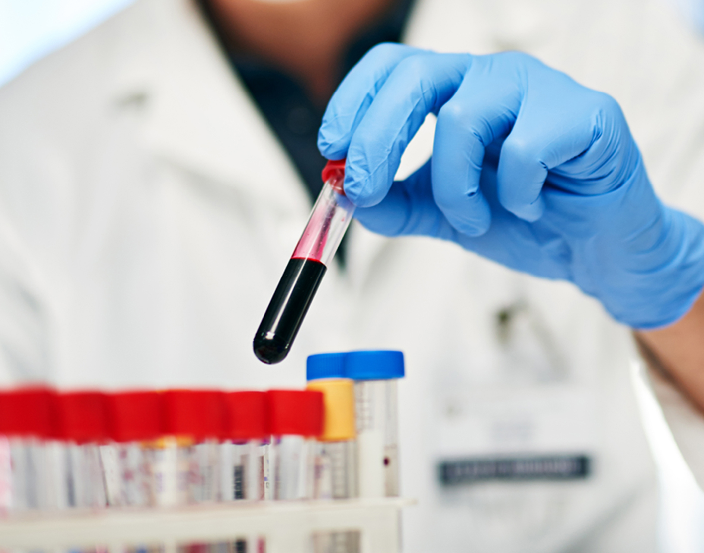 d-dimer-test-708x556-2x