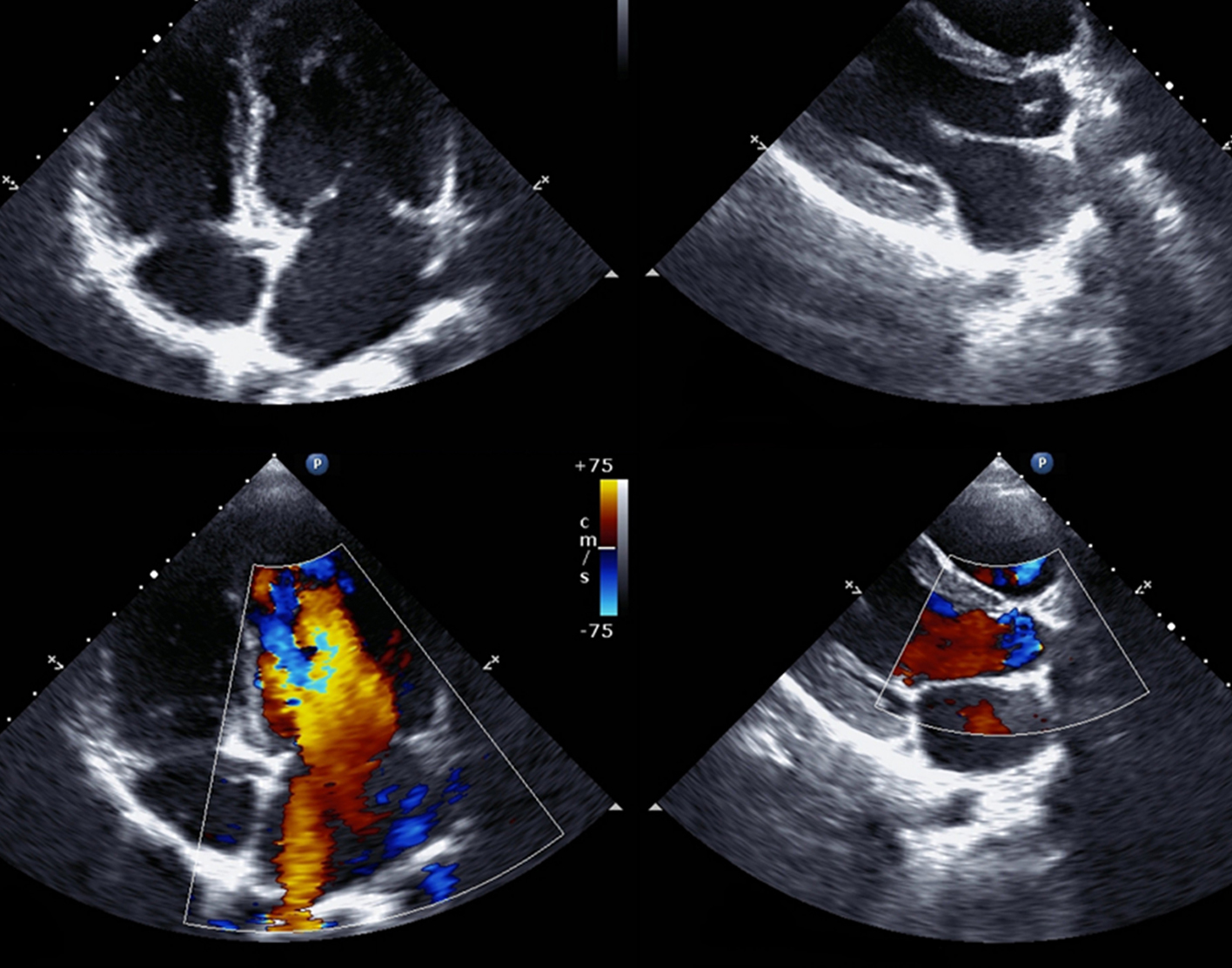 echocardiogram-708x556-2x
