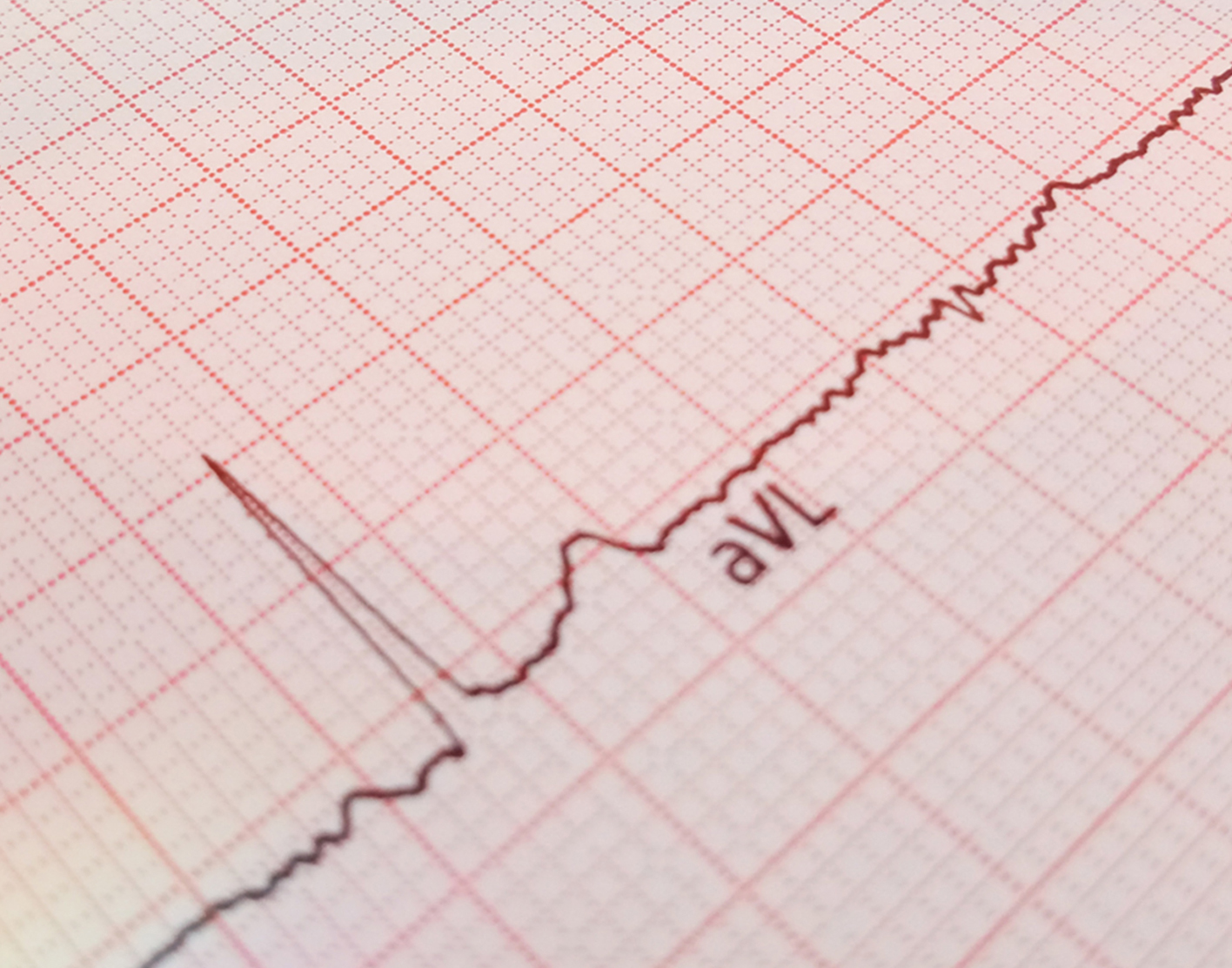 electrocardiogram-708x556-2x