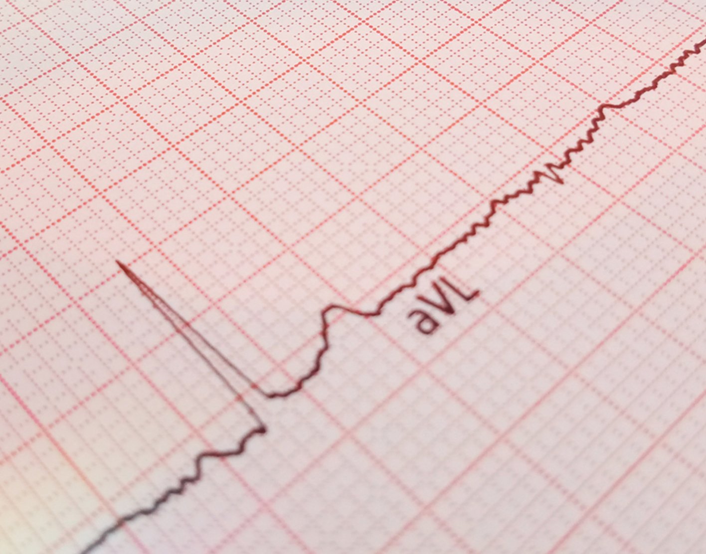 electrocardiogram-708x556-2x
