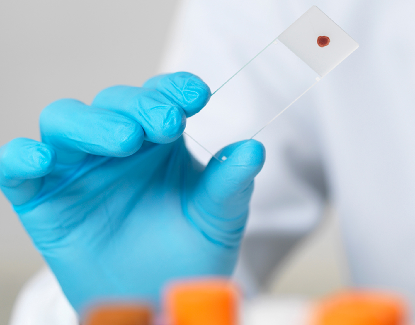 Febrile/cold agglutinins