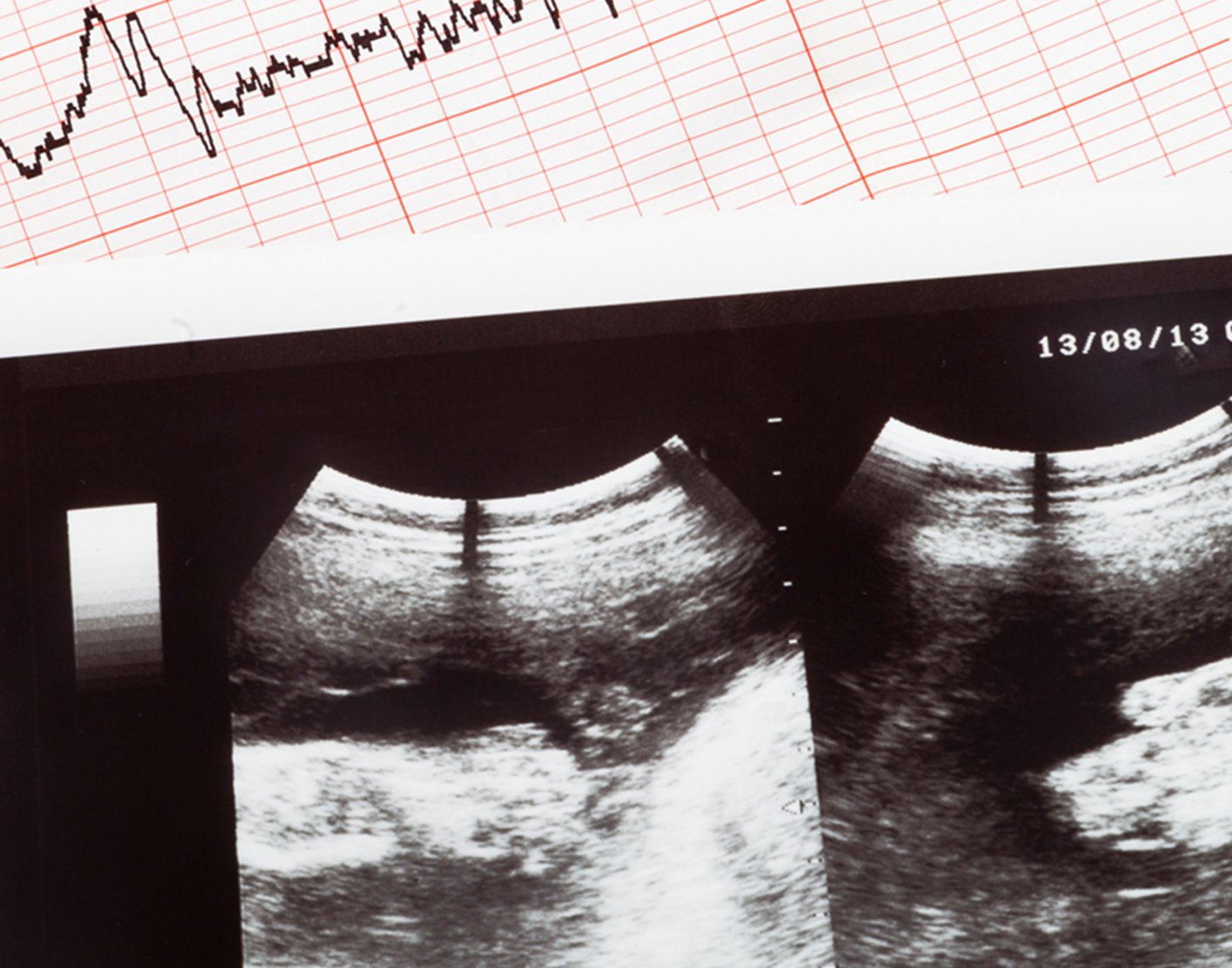 fetal-echocardiography-708x556-2x