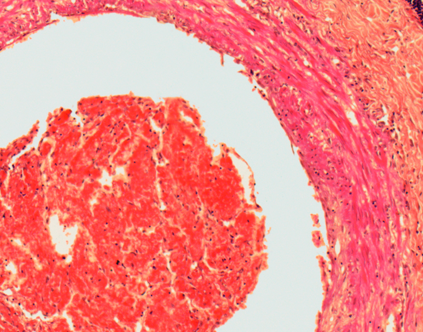 fibrinopeptide-a-blood-test-708x556-2x