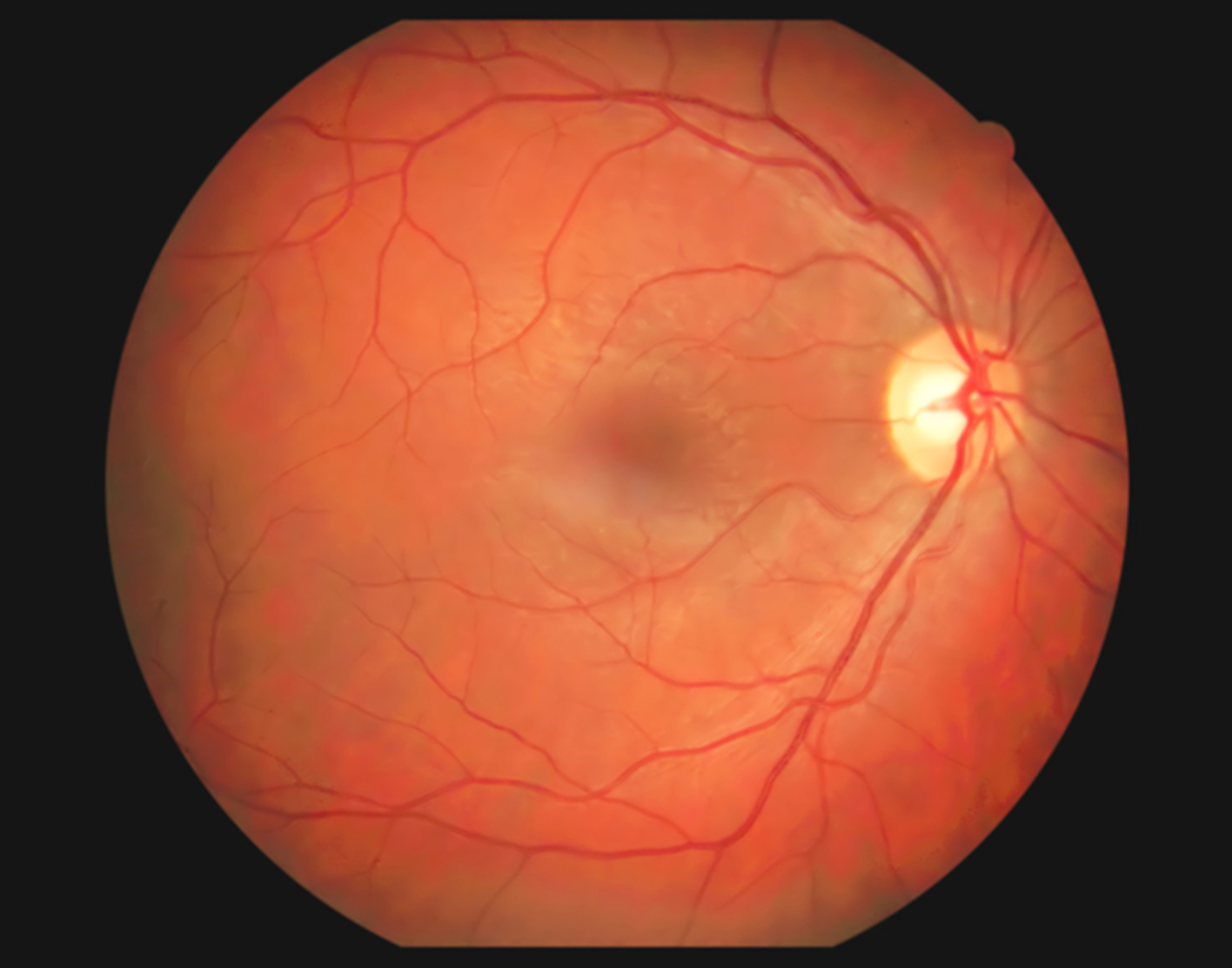 fluorescein-angiography-708x556-2x