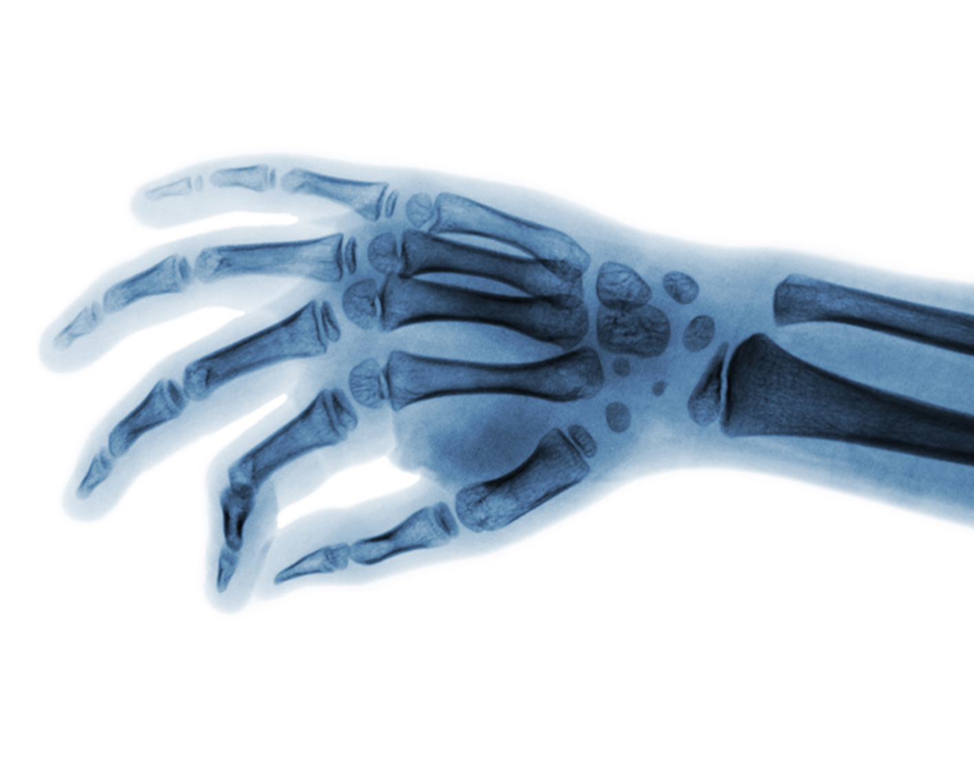hand-x-ray-708x556-2x
