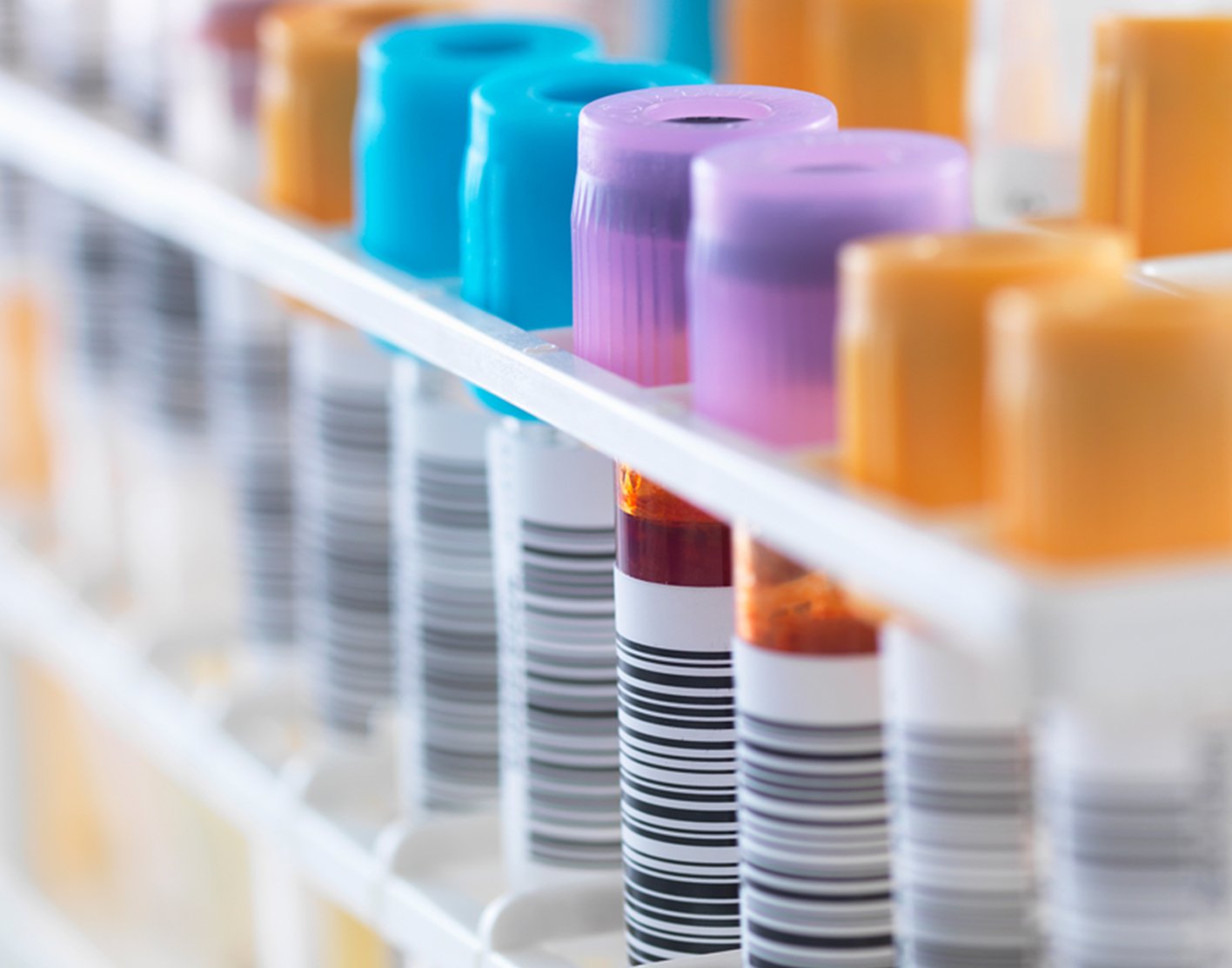 hemoglobinuria-test-708x556-2x