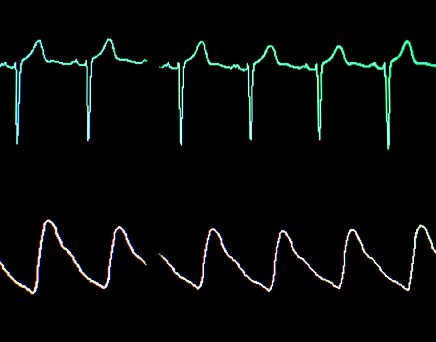 his-bundle-electrography-708x556-2x