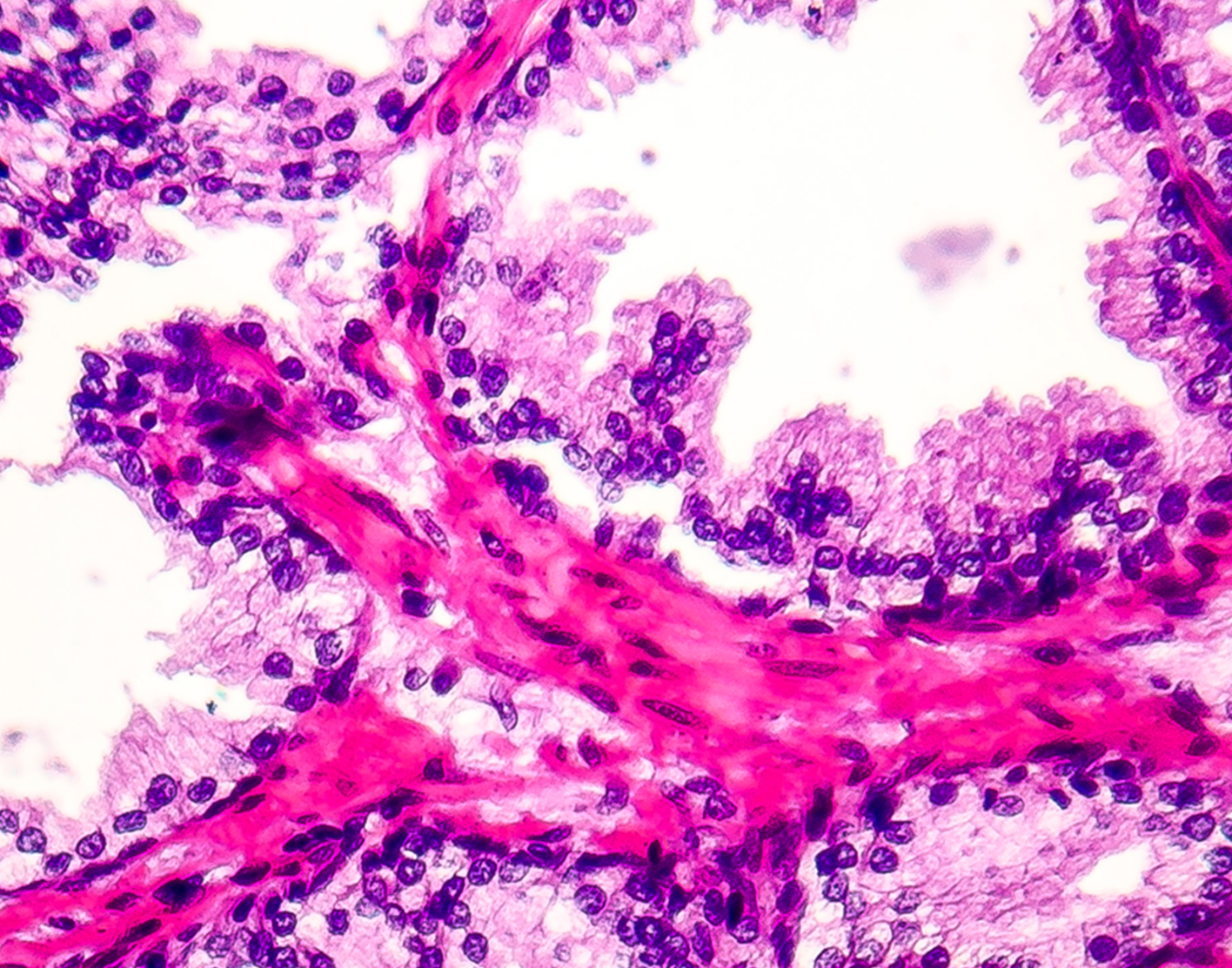hyperplasia-708x556-2x