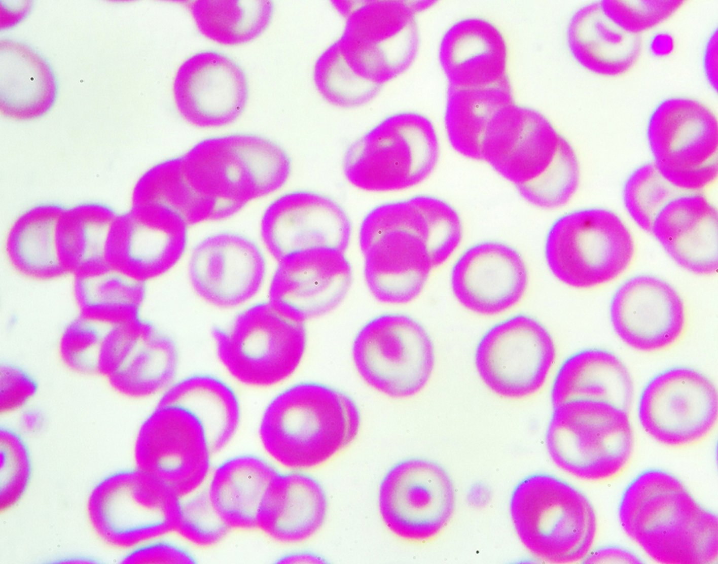 hypochromia-708x556-2x