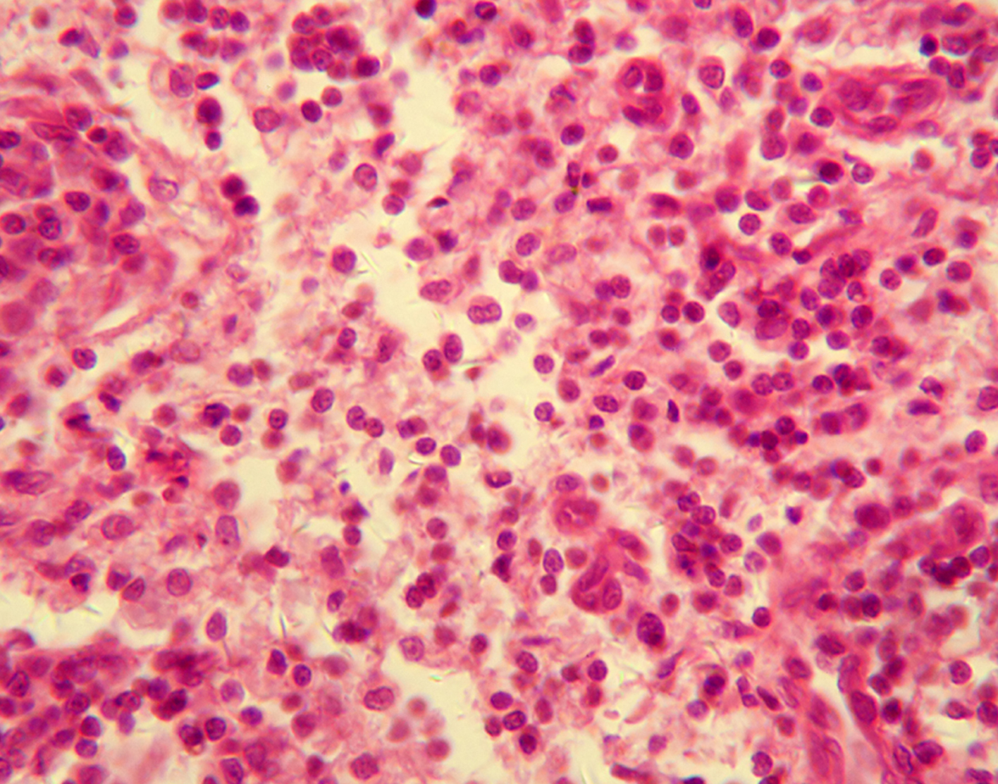 mediastinoscopy-with-biopsy-708x556-2x