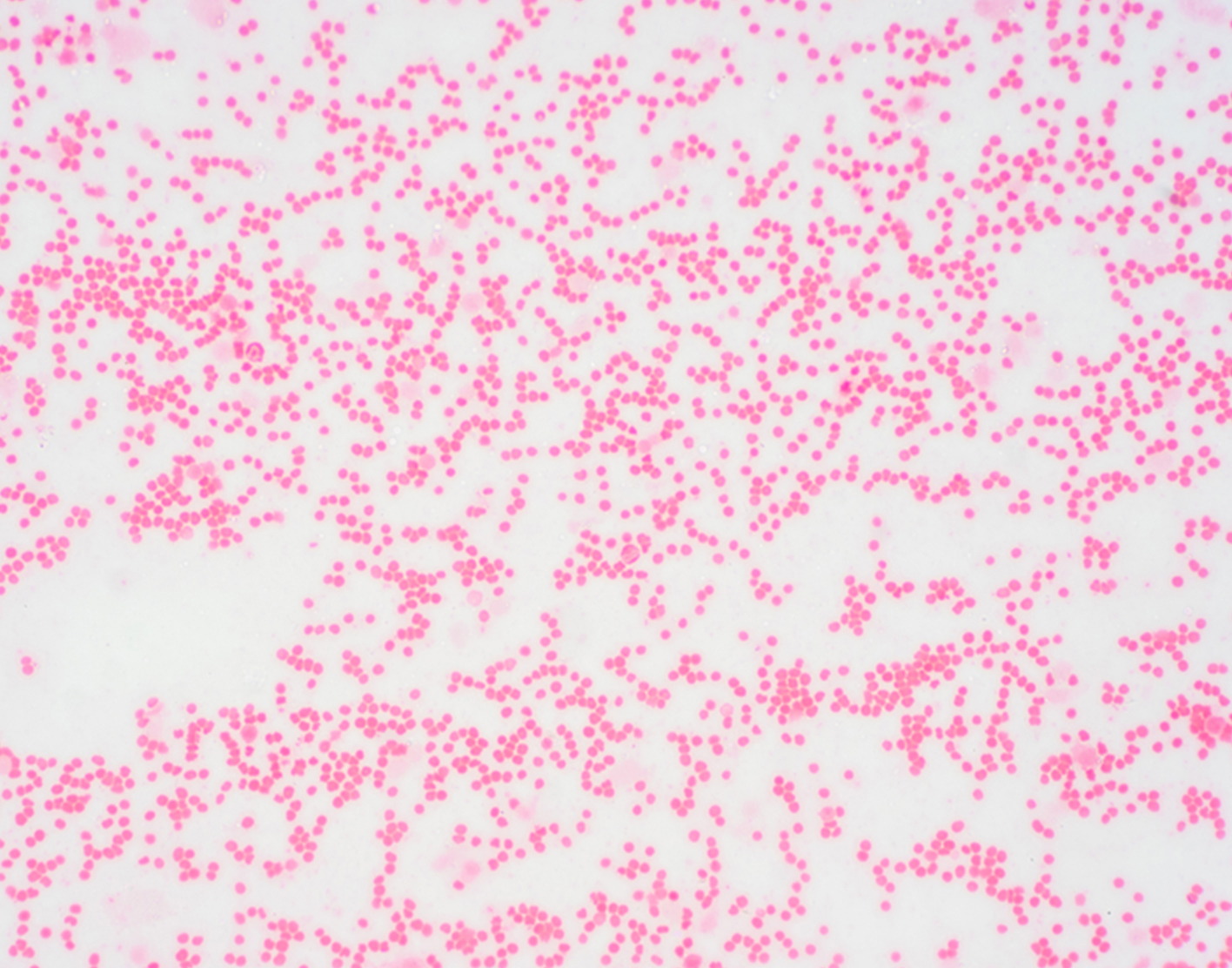 myelodysplastic-syndrome-708x556-2x
