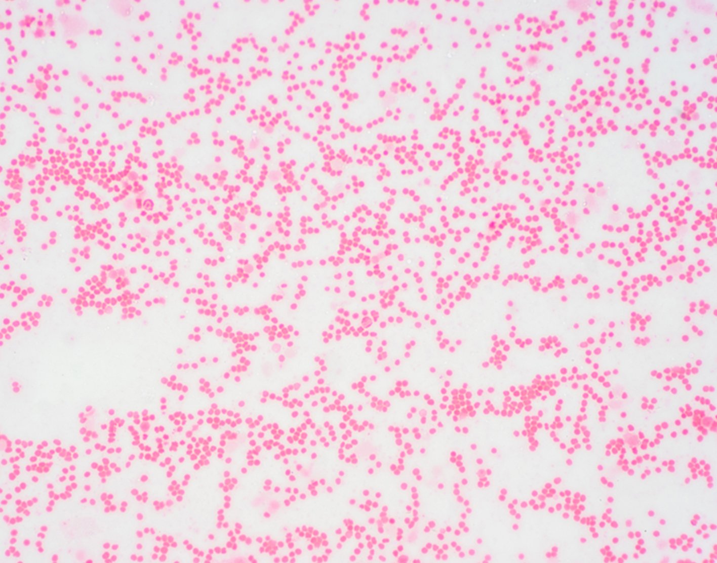 myelodysplastic-syndrome-708x556-2x