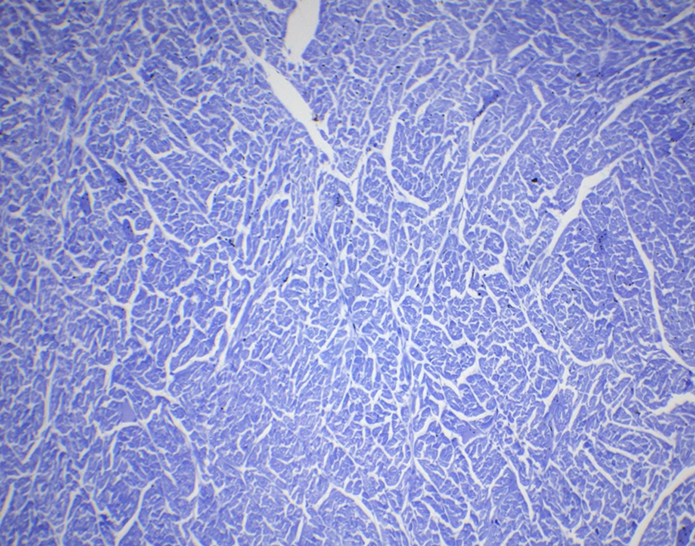 myocardial-biopsy-708x556-2x