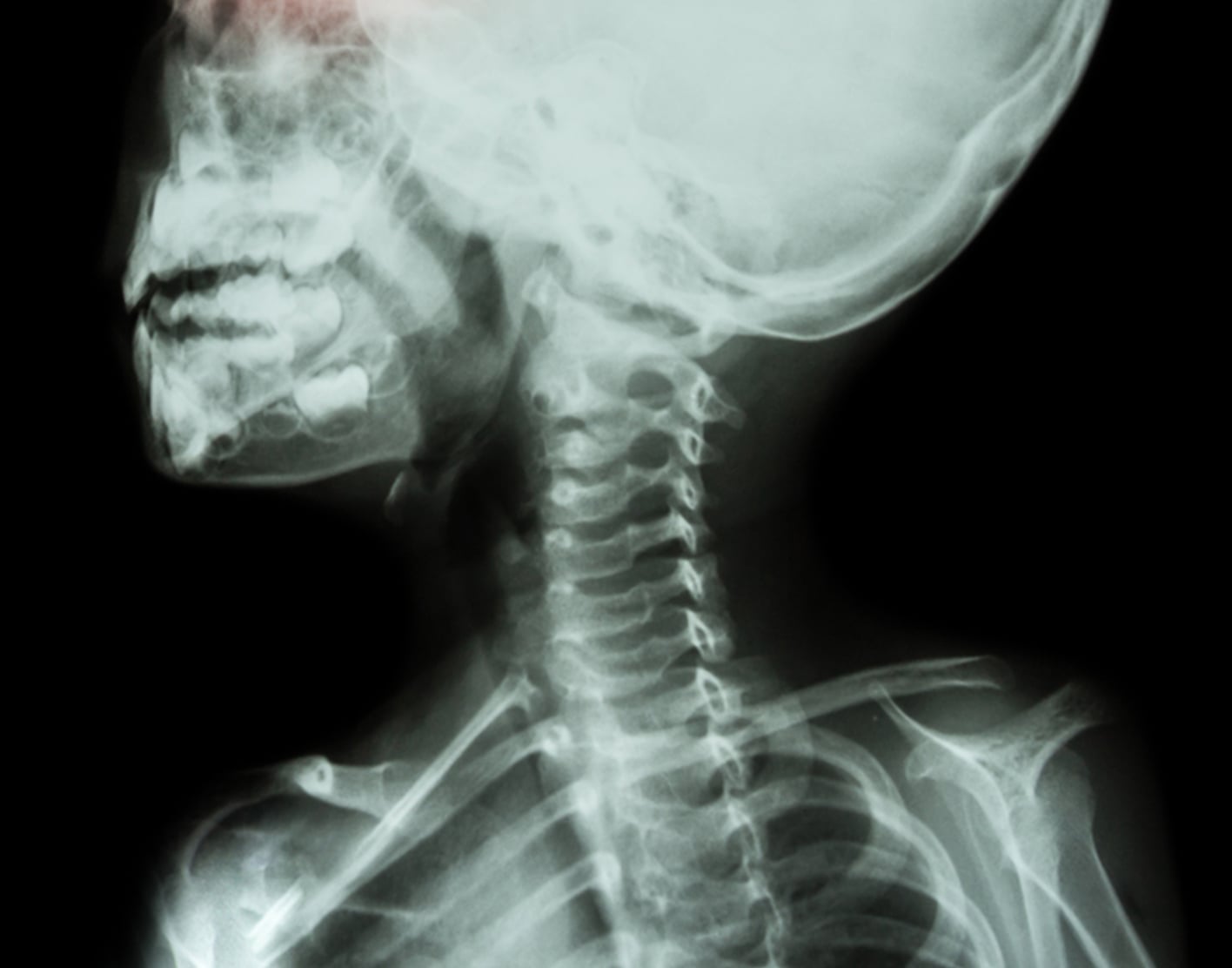 Neck x-ray