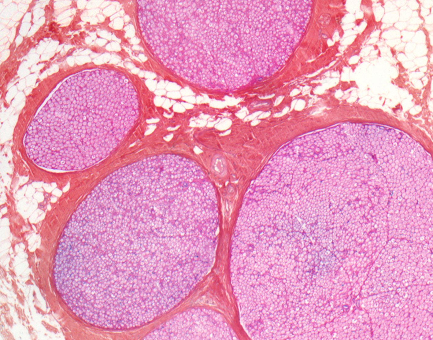 nerve-biopsy-708x556-2x