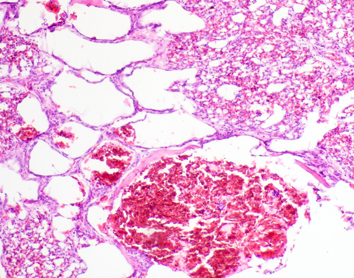 open-lung-biopsy-708x556-2x