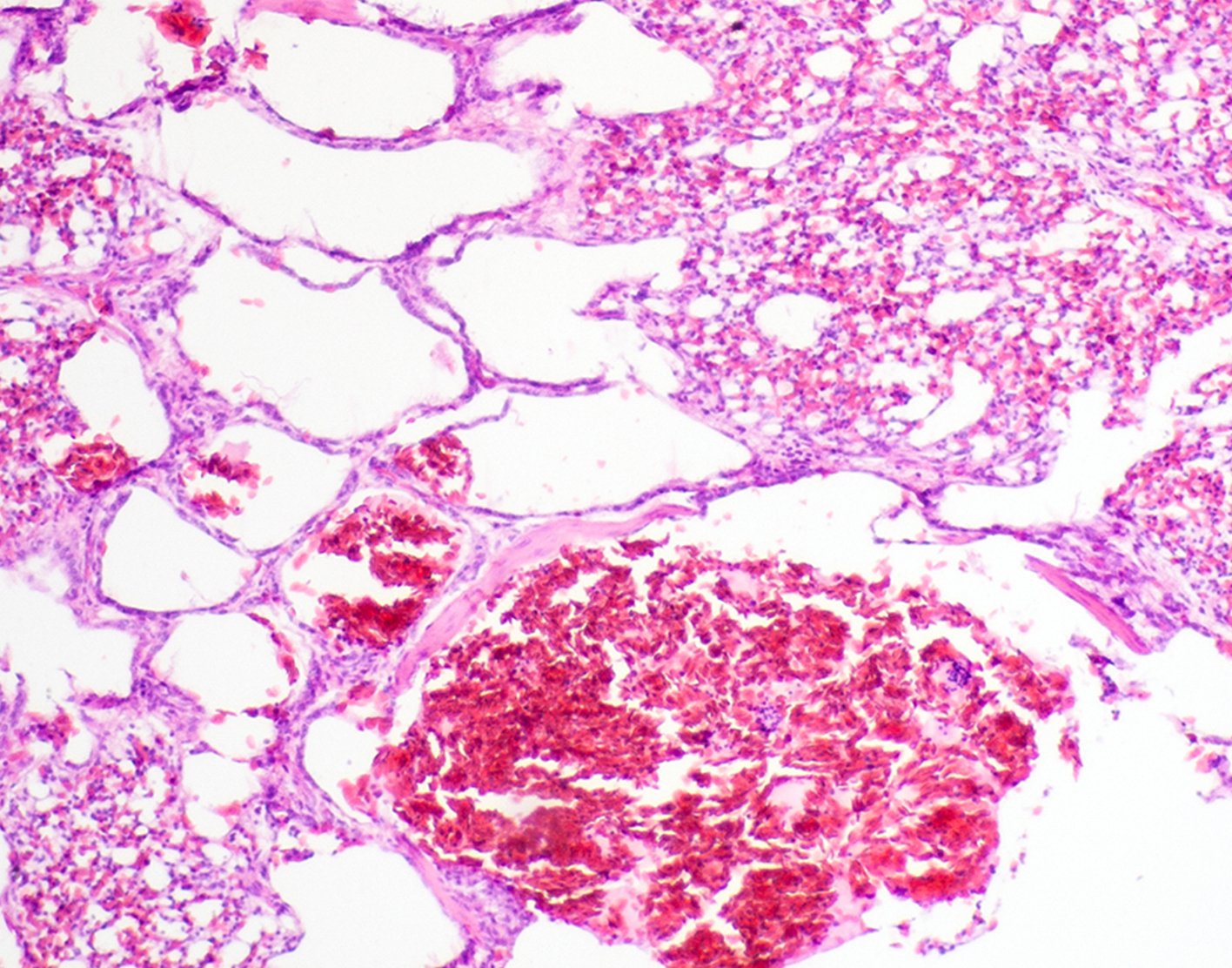 open-lung-biopsy-708x556-2x