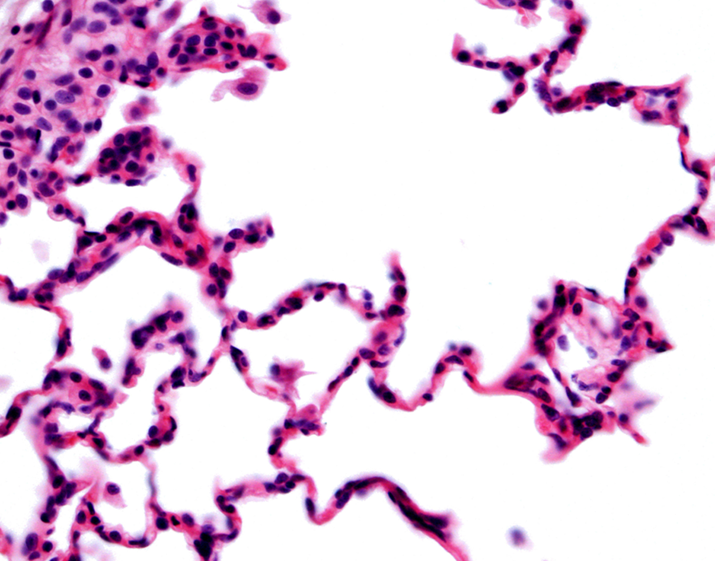 pleural-needle-biopsy-708x556-2x