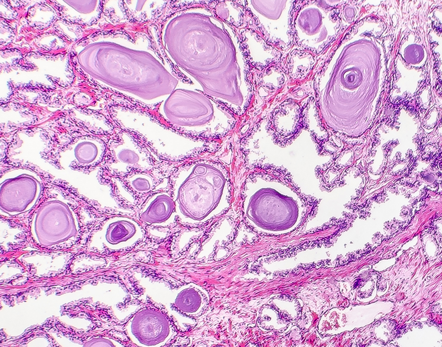 prostate-biopsy-708x556-2x