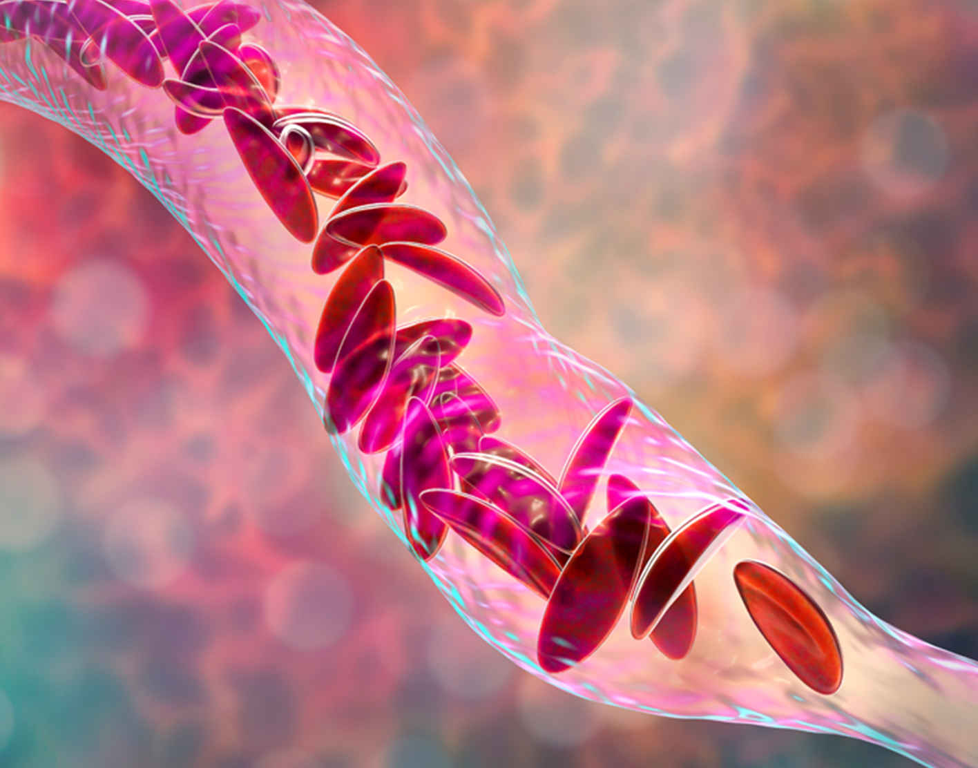 sickle-cell-test-708x556-2x