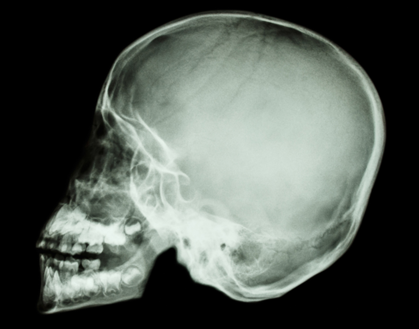 Skull x-ray