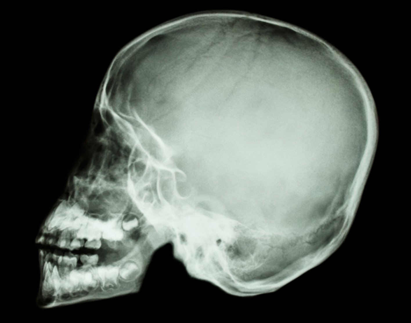 Skull x-ray
