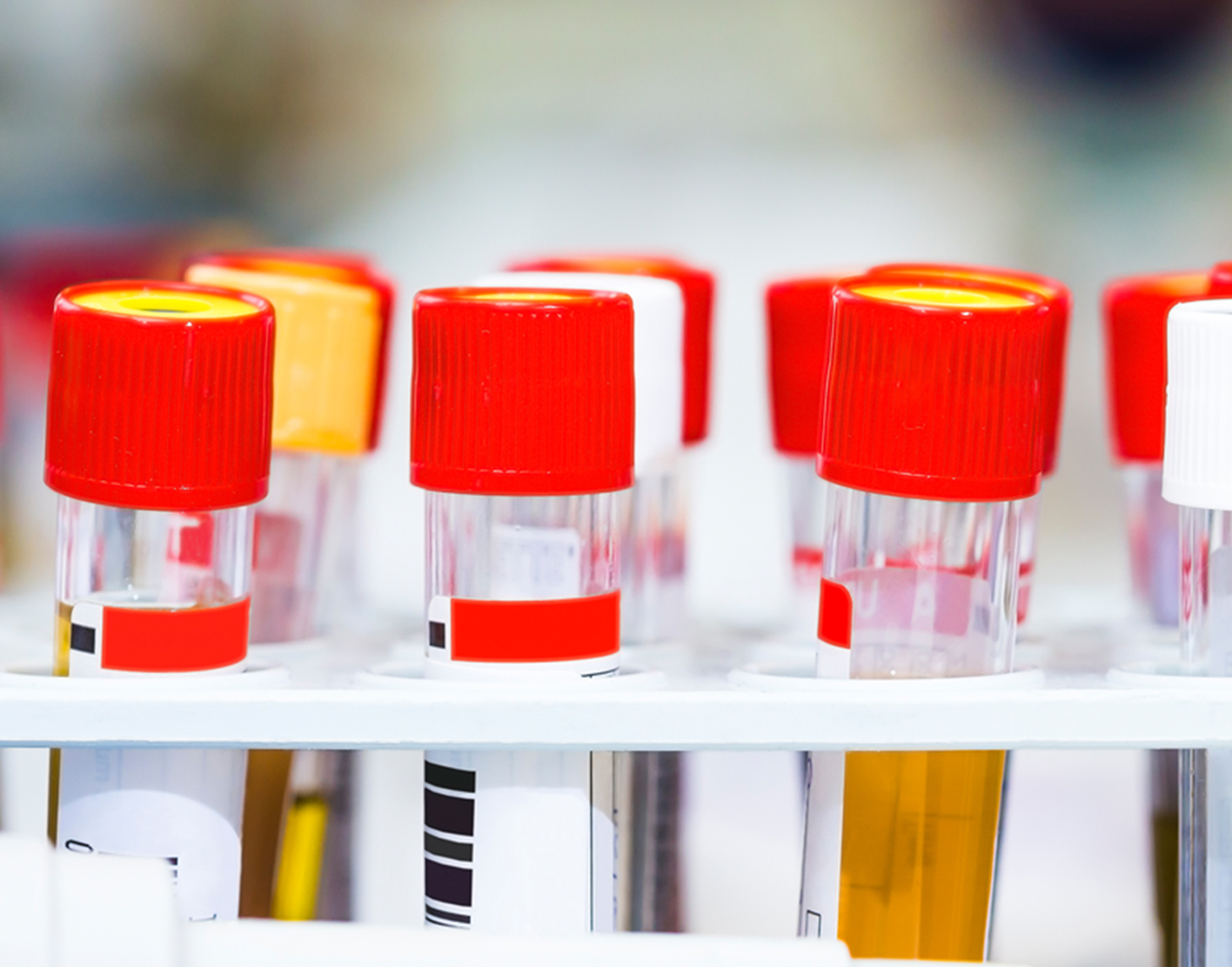 sodium-urine-test-708x556-2x