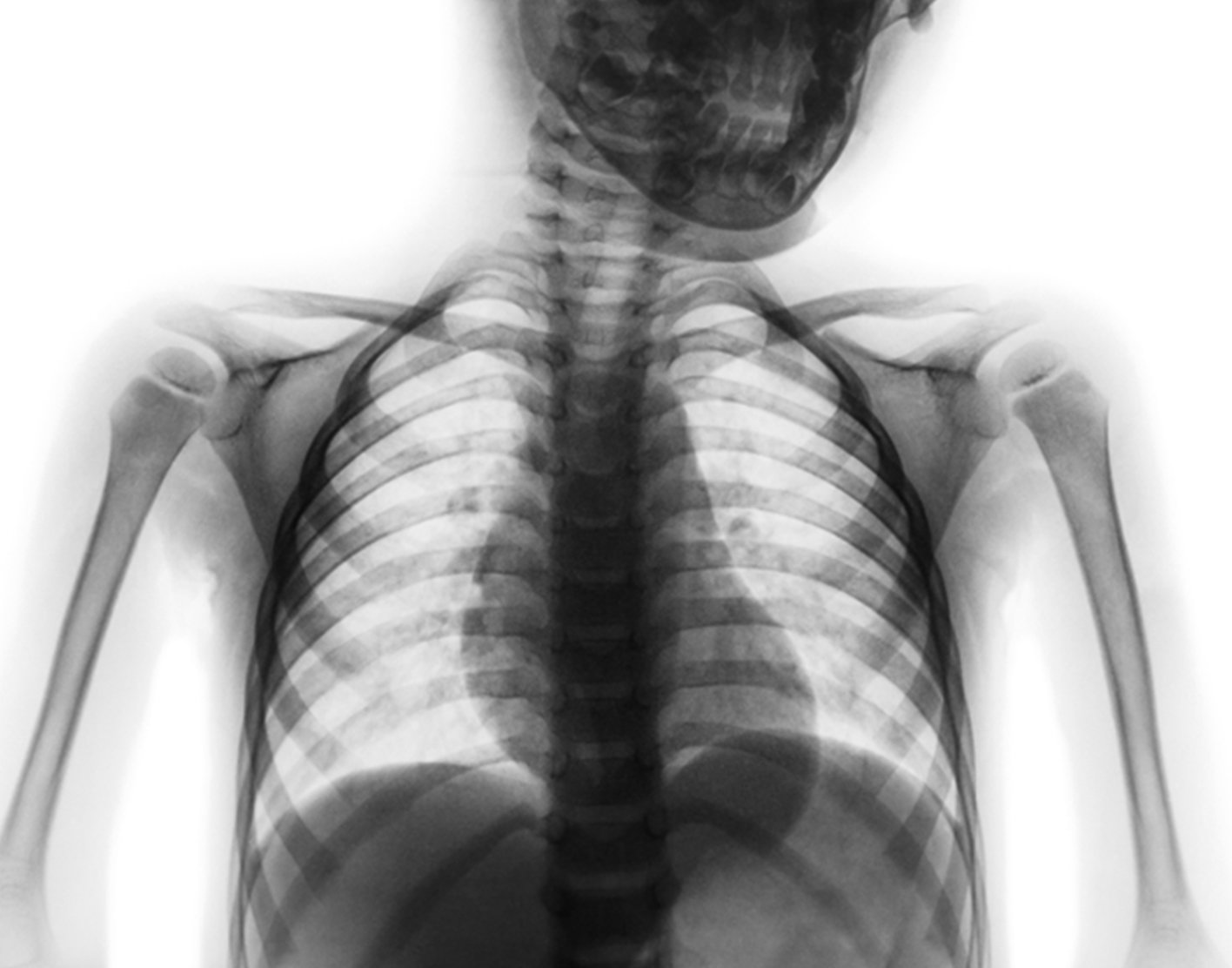 thoracic-spine-x-ray-708x556-2x