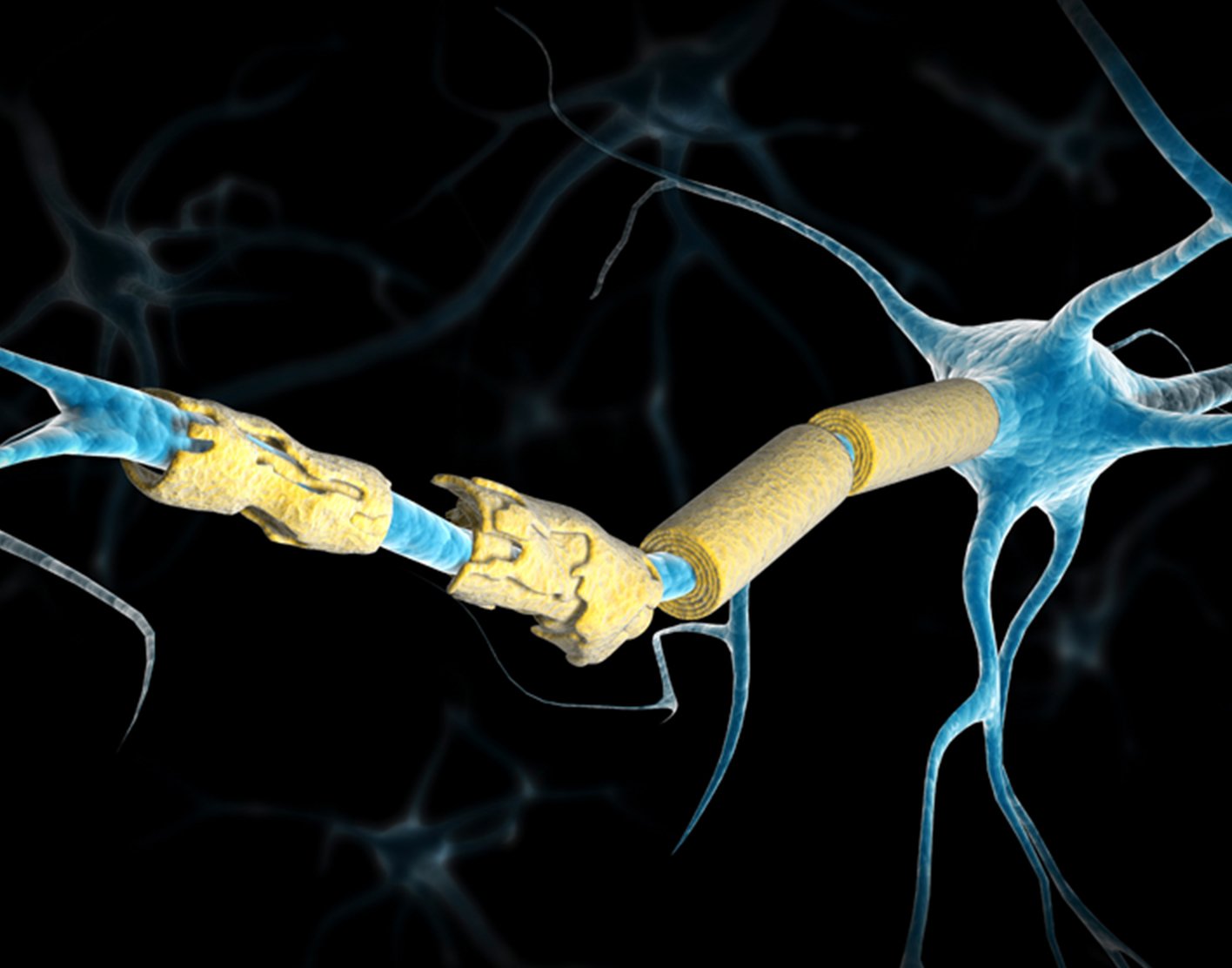 transverse-myelitis-708x556-2x